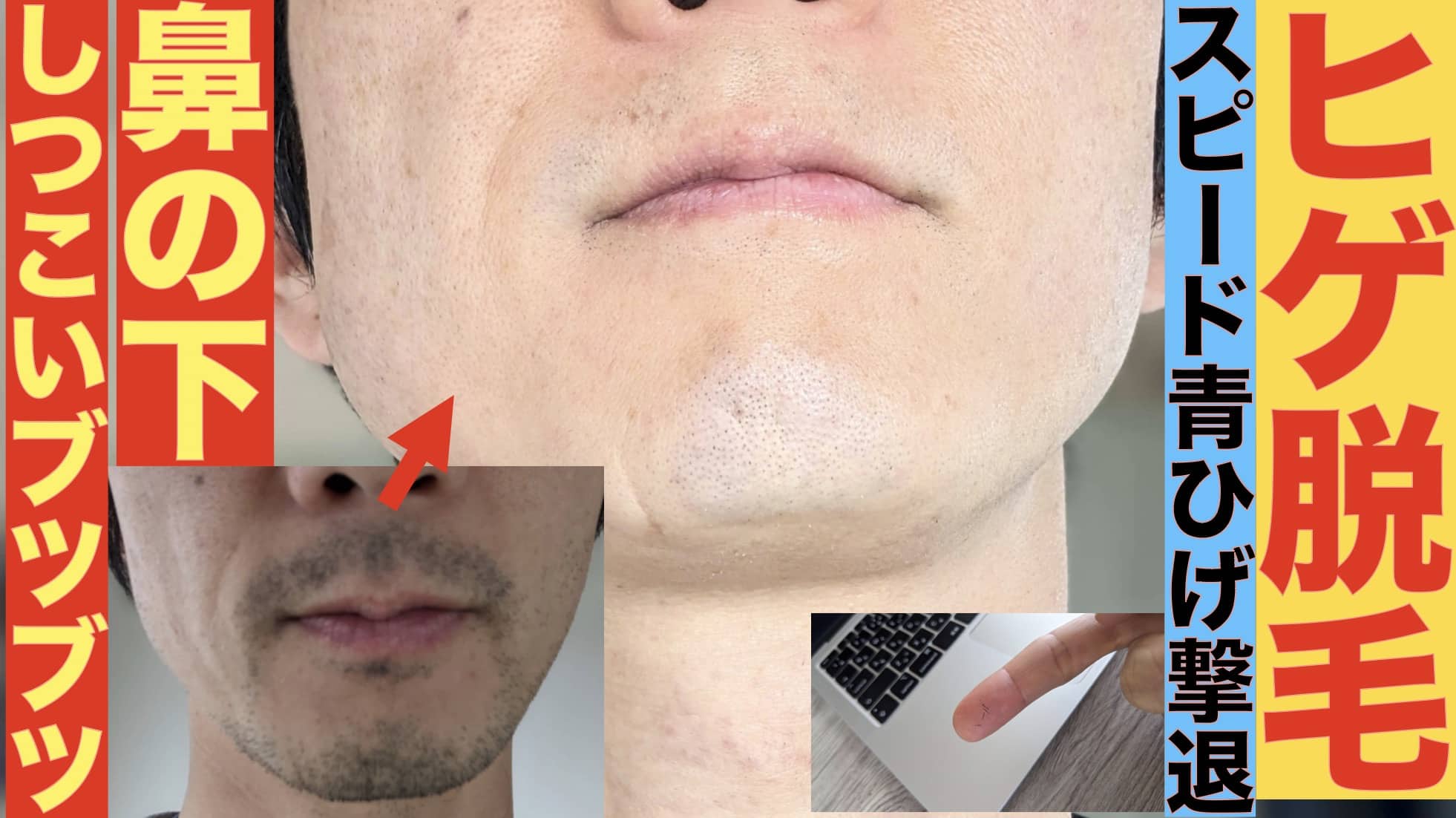 【ヒゲ脱毛】鼻の下のブツブツ青ヒゲを撃退したいなら1回2800円の湘南美容クリニックがおすすめな理由サムネイル画像