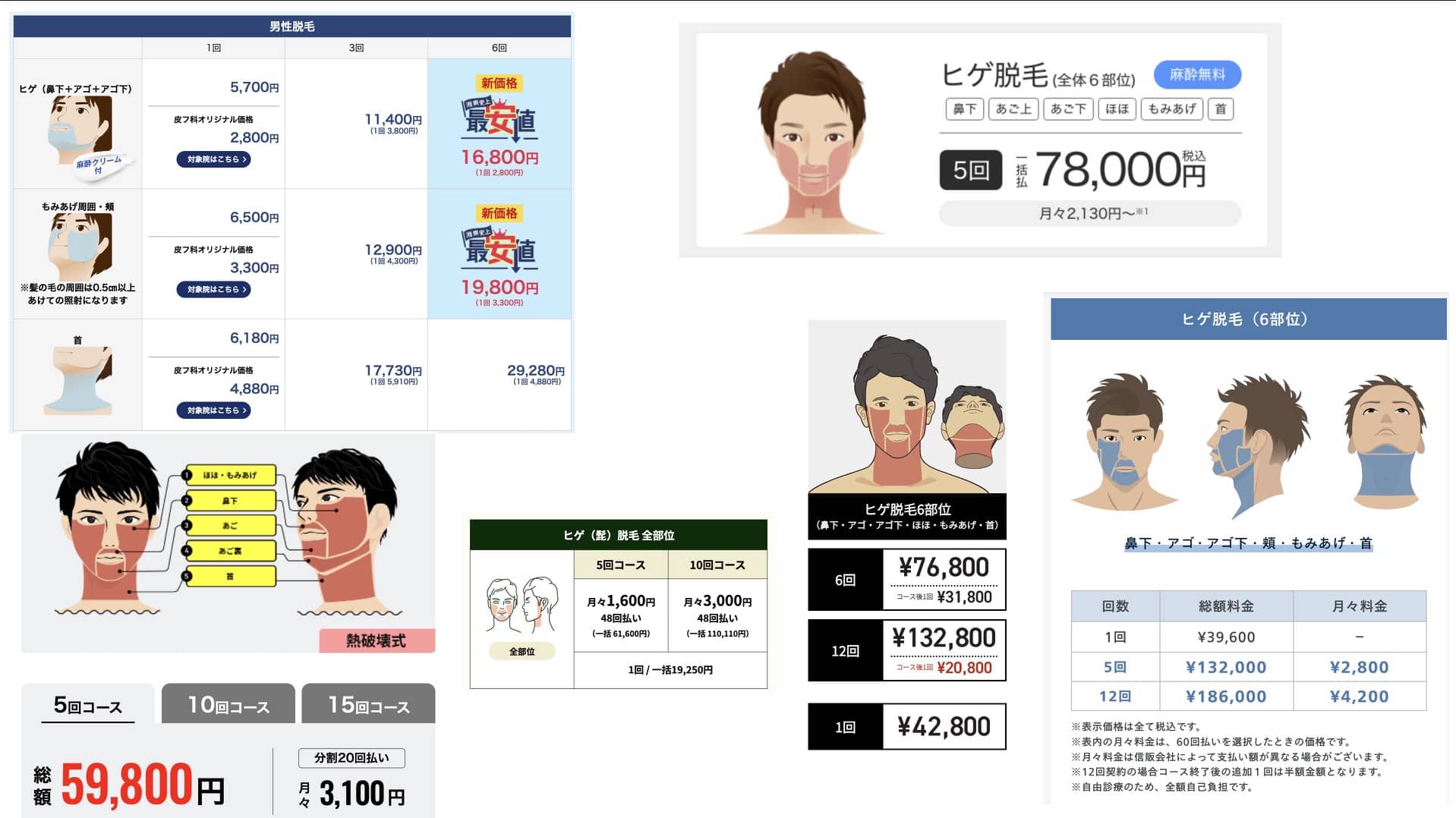各クリニックの1万円台ヒゲ医療レーザー脱毛の料金表画像