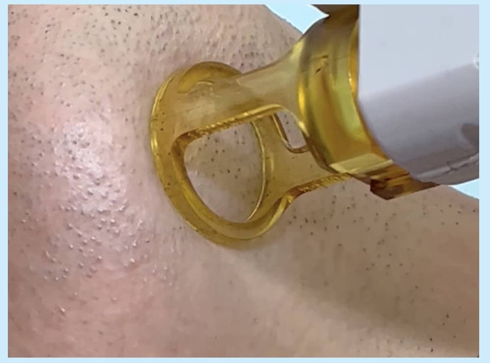 湘南美容クリニックの医療レーザー脱毛照射の様子。