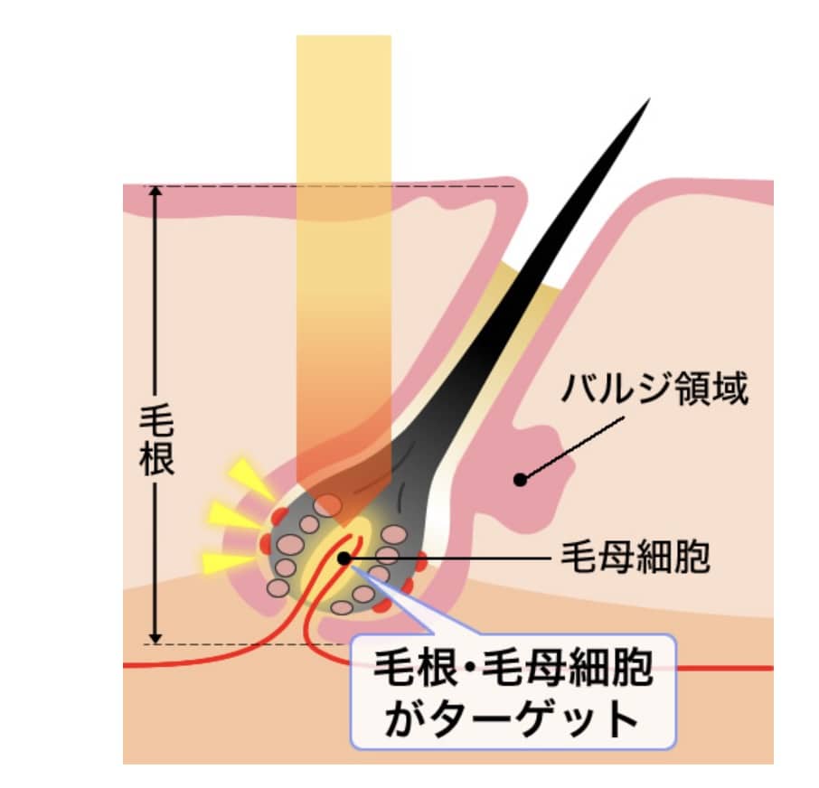 熱破壊式マシンの肌の影響のイラスト