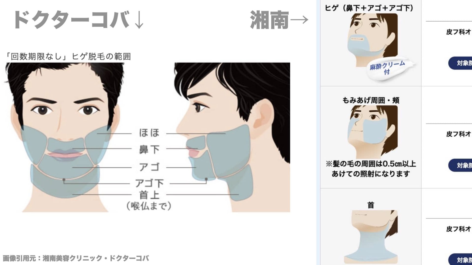 ドクターコバと湘南美容クリニックのヒゲ脱毛照射範囲の違い