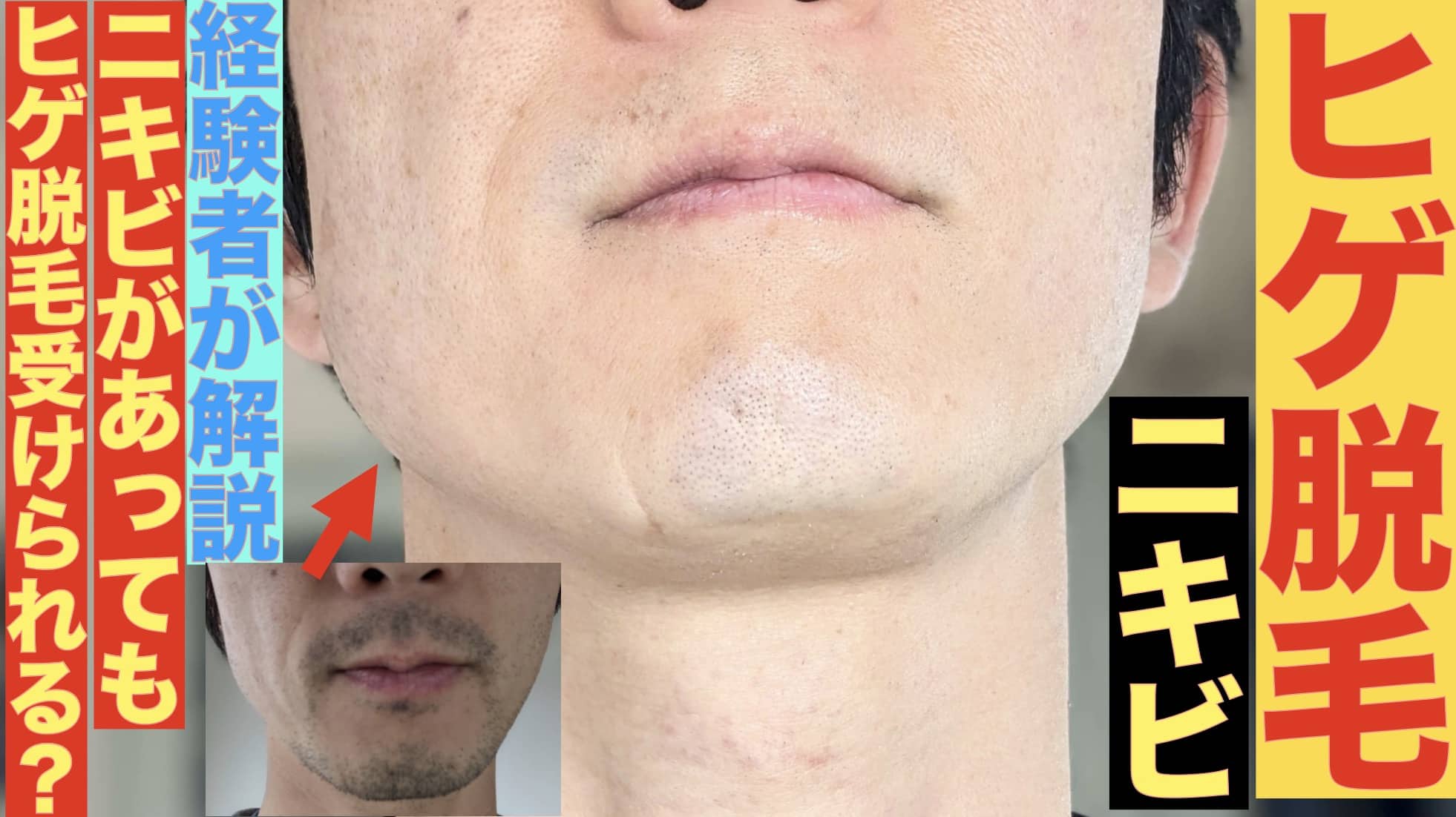 ニキビあるけどヒゲ脱毛できる？12回経験者が解説！「〇〇によって対応が変わる」サムネイル画像