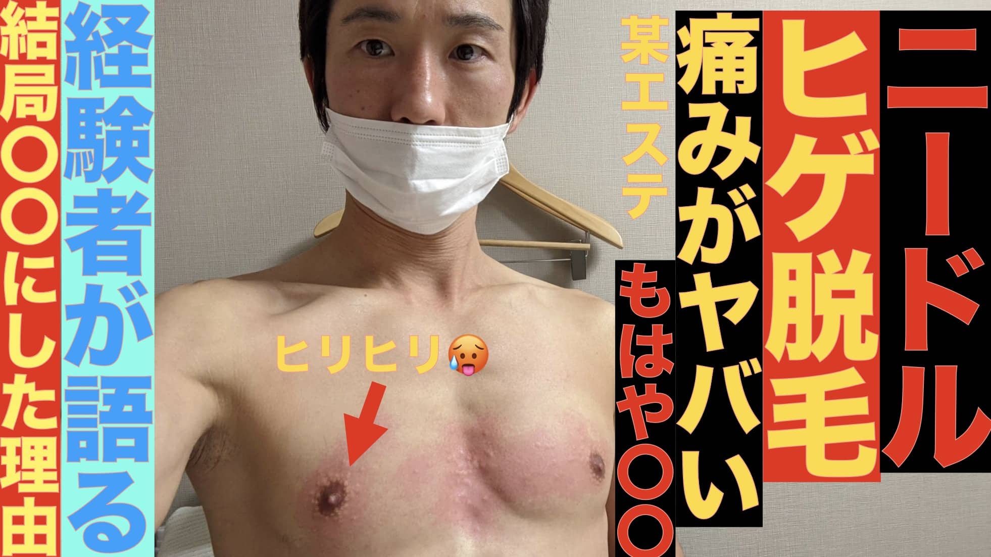 ニードルヒゲ脱毛はやめとけ！有名な〇〇に行って後悔したぼくが警告。今は医療レーザー脱毛がおすすめサムネイル画像