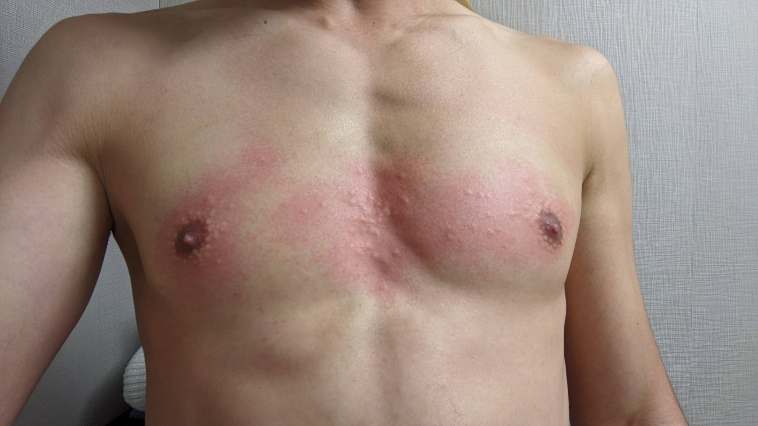 某エステでニードル脱毛体験。胸の赤み写真。