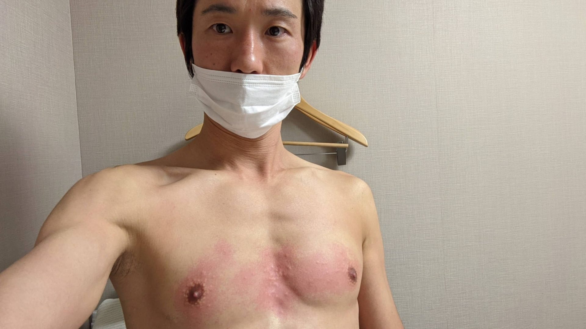 某エステでニードル脱毛体験。この時は胸でしたが、激痛...涙。髭はさらに痛いみたいなので、断念しました。