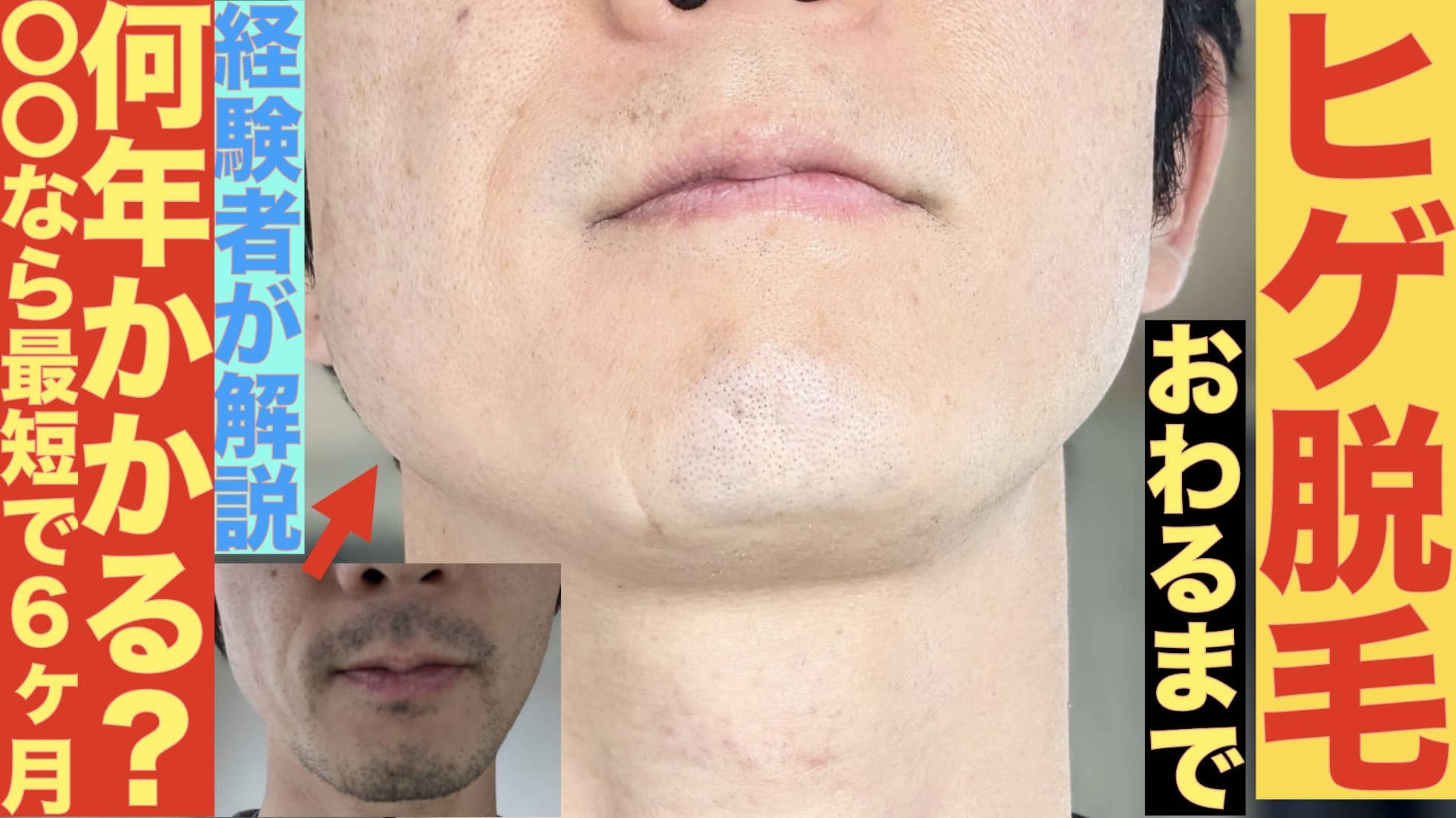 ヒゲ脱毛って何年かかる？湘南で12回やった筆者が解説「最短で〇ヶ月」サムネイル画像