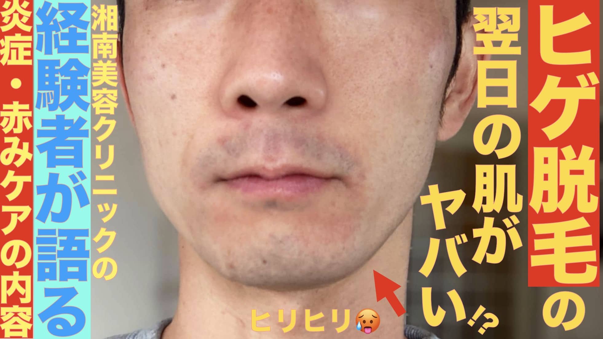 ヒゲ脱毛の次の日の肌が最悪？人に会えないレベルで炎症になる？経験者が解説サムネイル画像