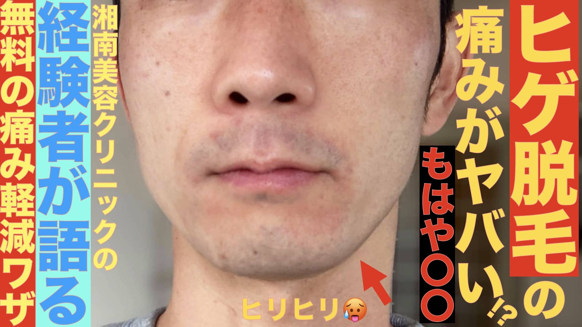 ヒゲ脱毛の痛さがヤバすぎ？経験者が涙ながらに語る「〇〇」みたいな痛みで思わず施術中に涙が.サムネイル画像