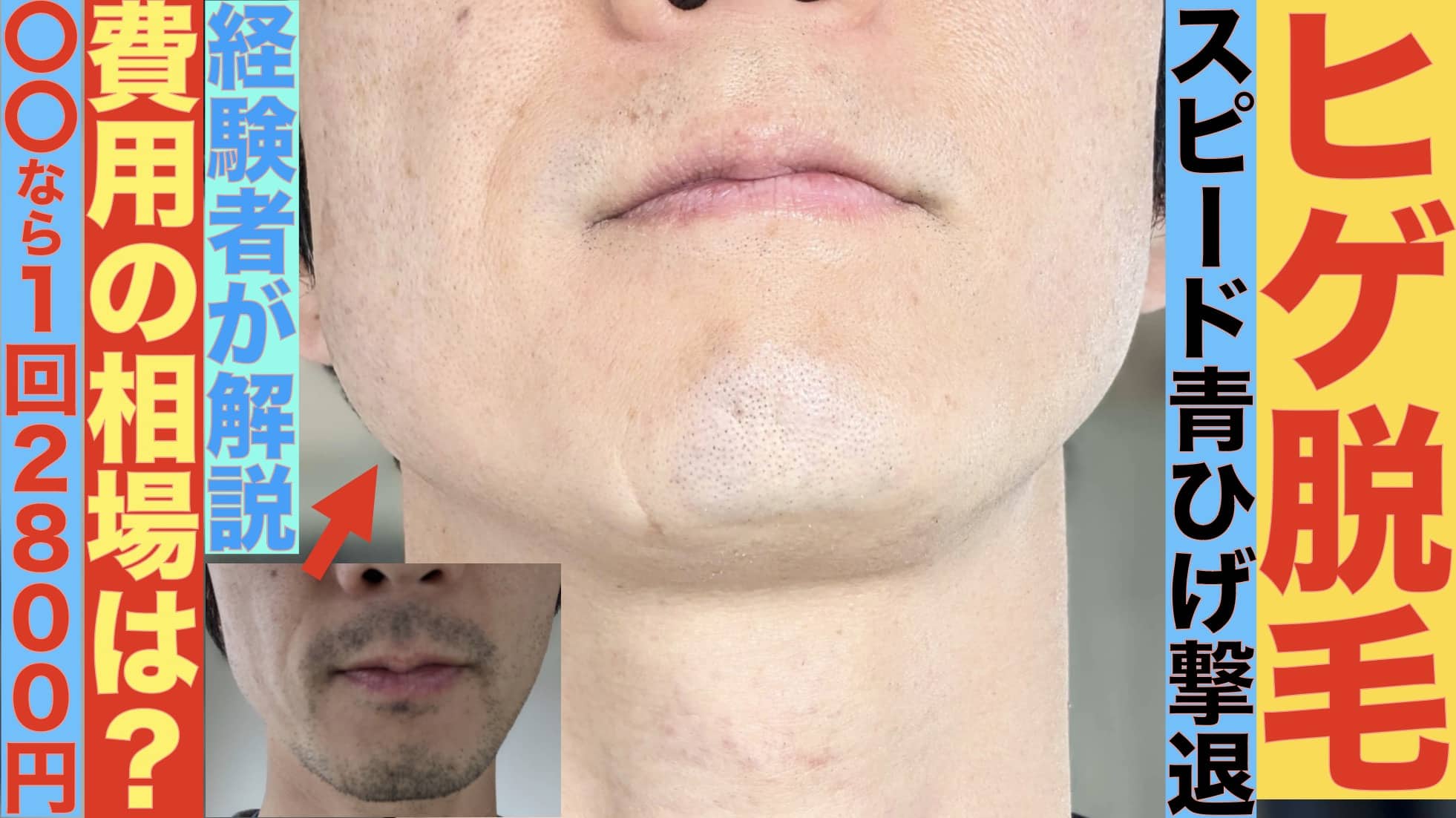 ヒゲ脱毛の費用の相場は？1回2800円で医療脱毛できる湘南美容クリニックのコスパがよいサムネイル画像