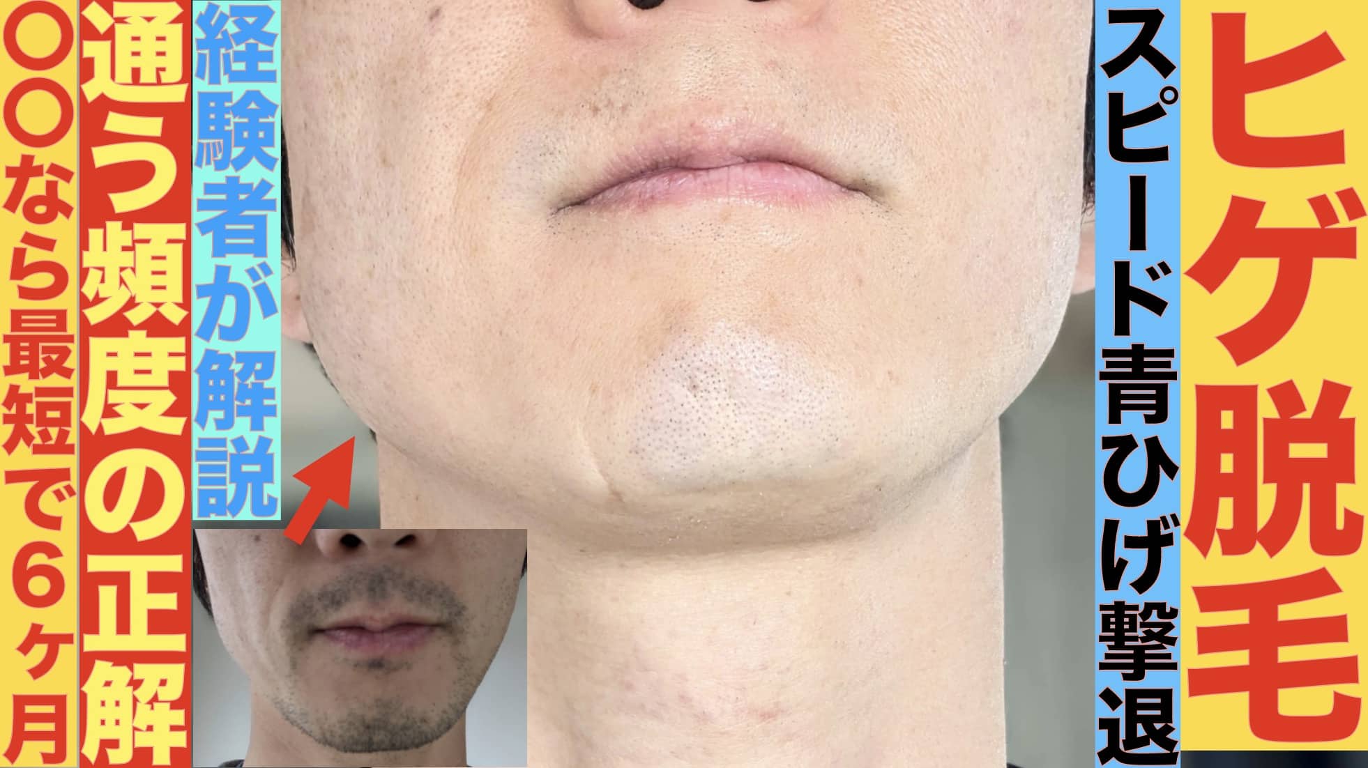 ヒゲ脱毛の頻度の目安は？湘南美容クリニックなら月イチで通えて半年で青ヒゲがかなり減ったのでおすすめサムネイル画像