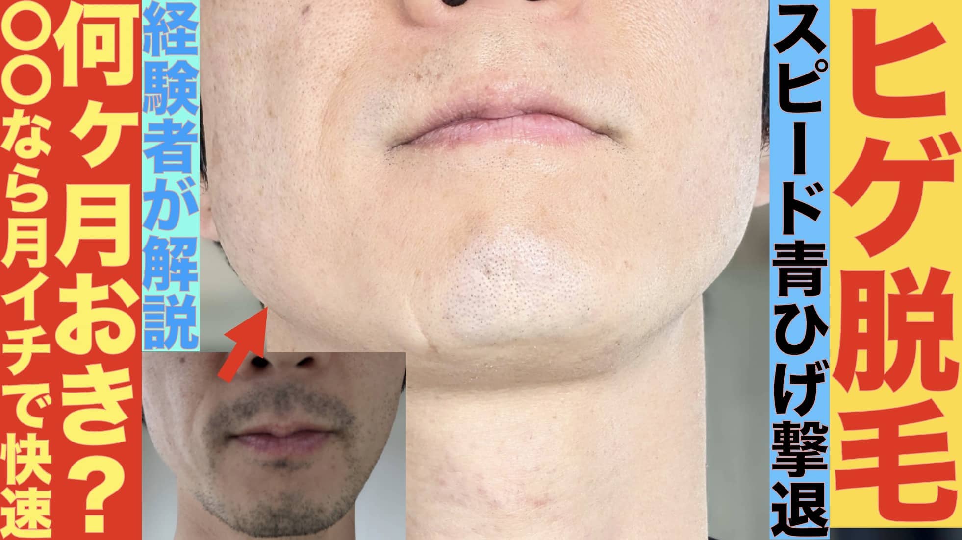 ヒゲ脱毛は何ヶ月おきに通える？トータル終わるのはいつ？12回やった筆者が解説サムネイル画像