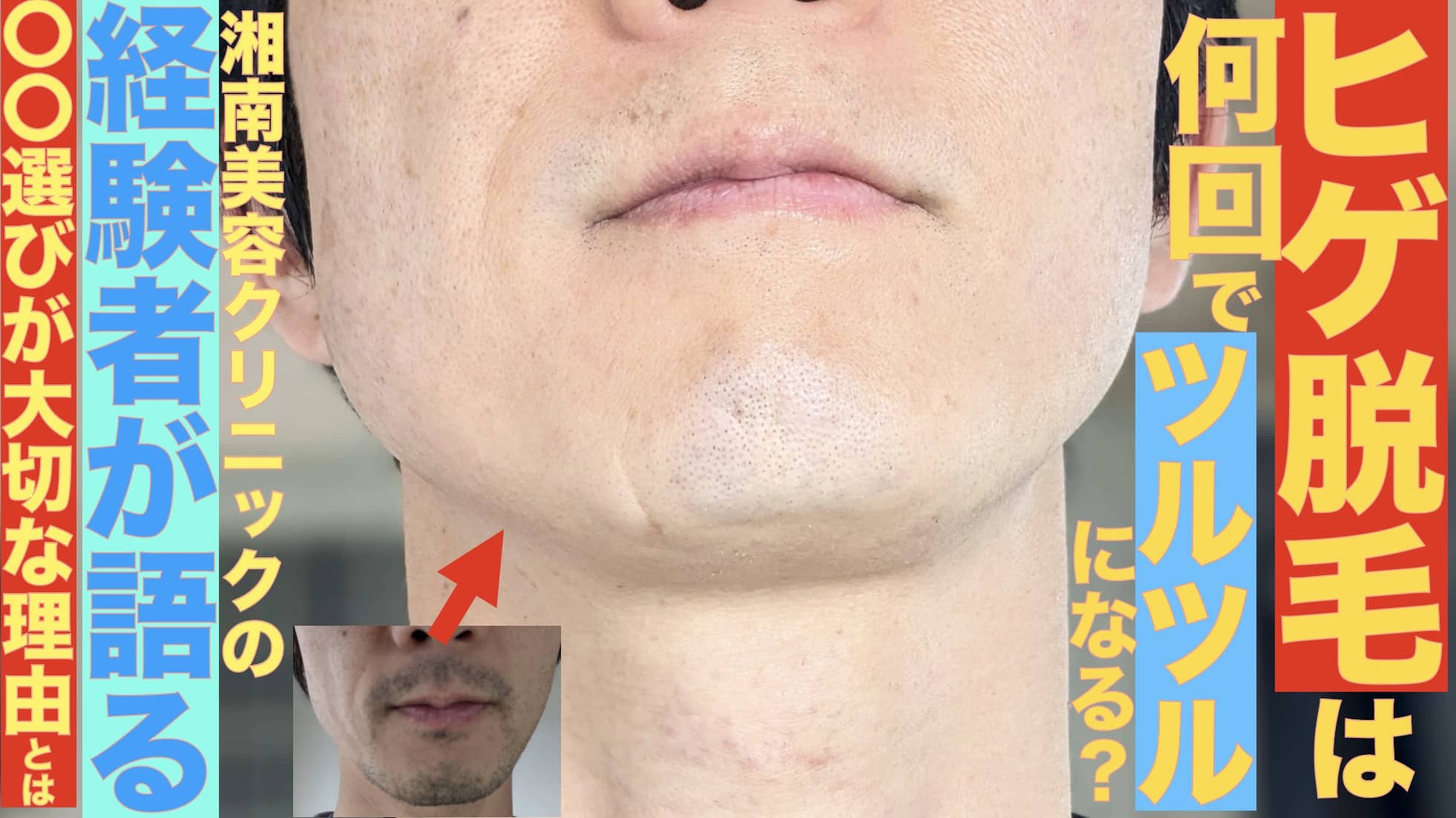 ヒゲ脱毛は何回でツルツルになる？湘南で12回やったぼくが解説します【画像あり】サムネイル画像