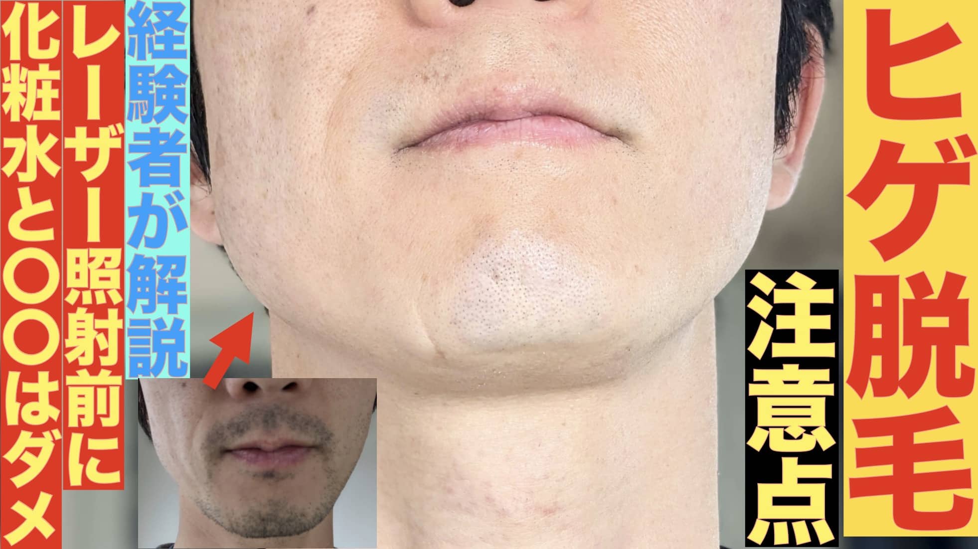 ヒゲ脱毛当日に化粧水は必要？12回受けた経験者が「〇〇を塗ると最悪の場合.」と話すサムネイル画像