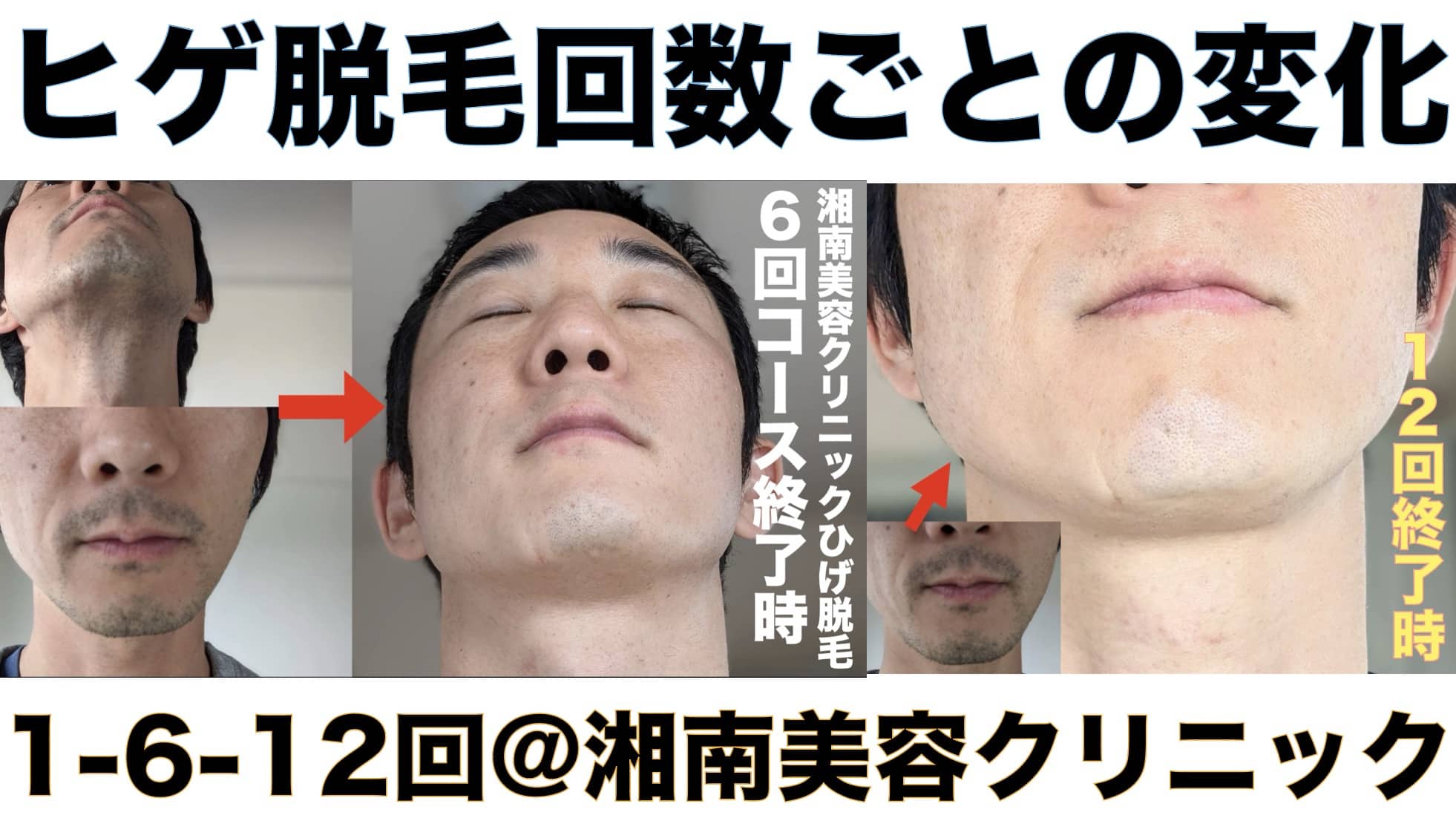ヒゲ脱毛1回・6回・12回それぞれの変化まとめ【湘南美容クリニックで医療脱毛を経験】サムネイル画像