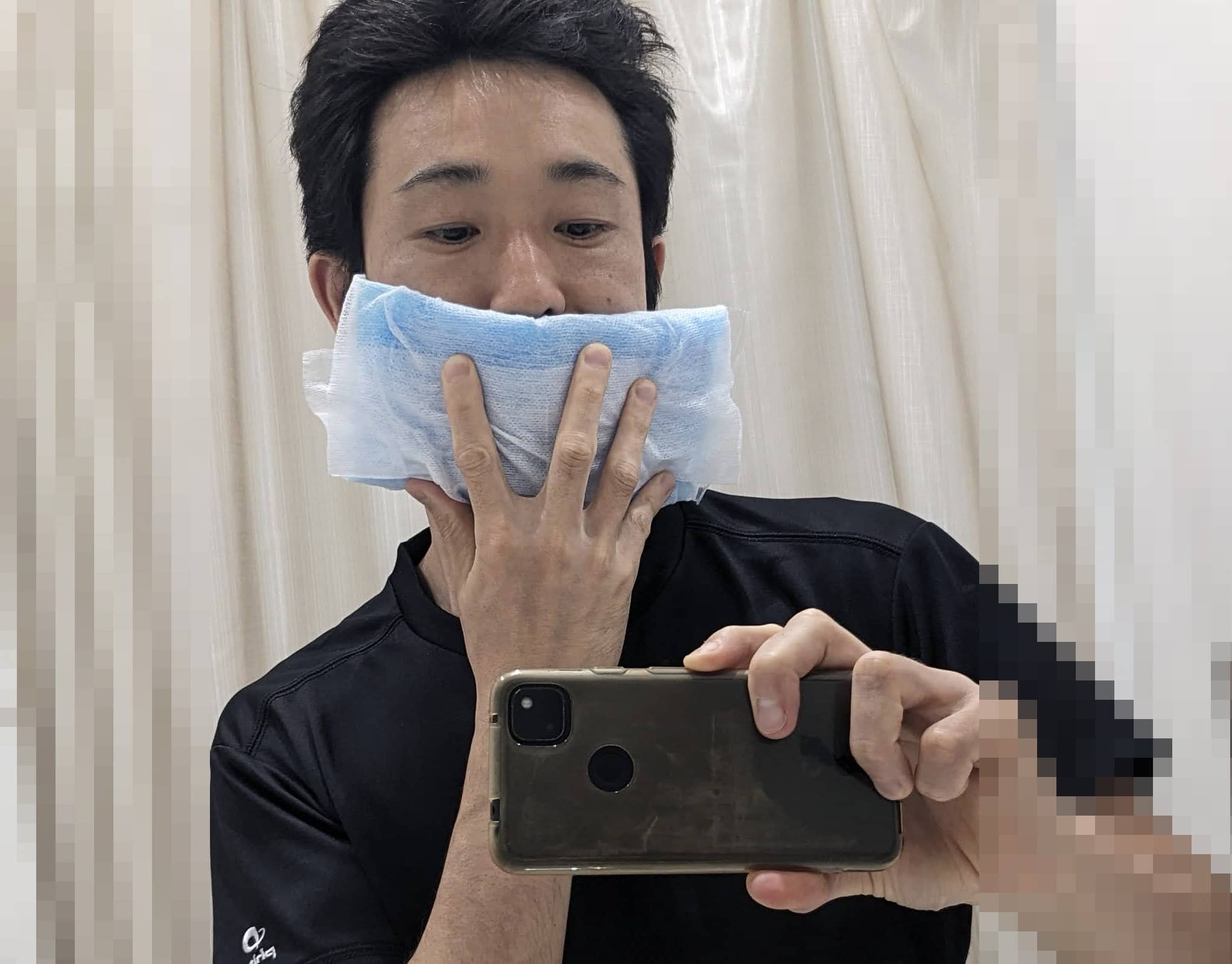 湘南美容クリニックのヒゲレーザー脱毛後にアイスノンで口元を冷やしている様子