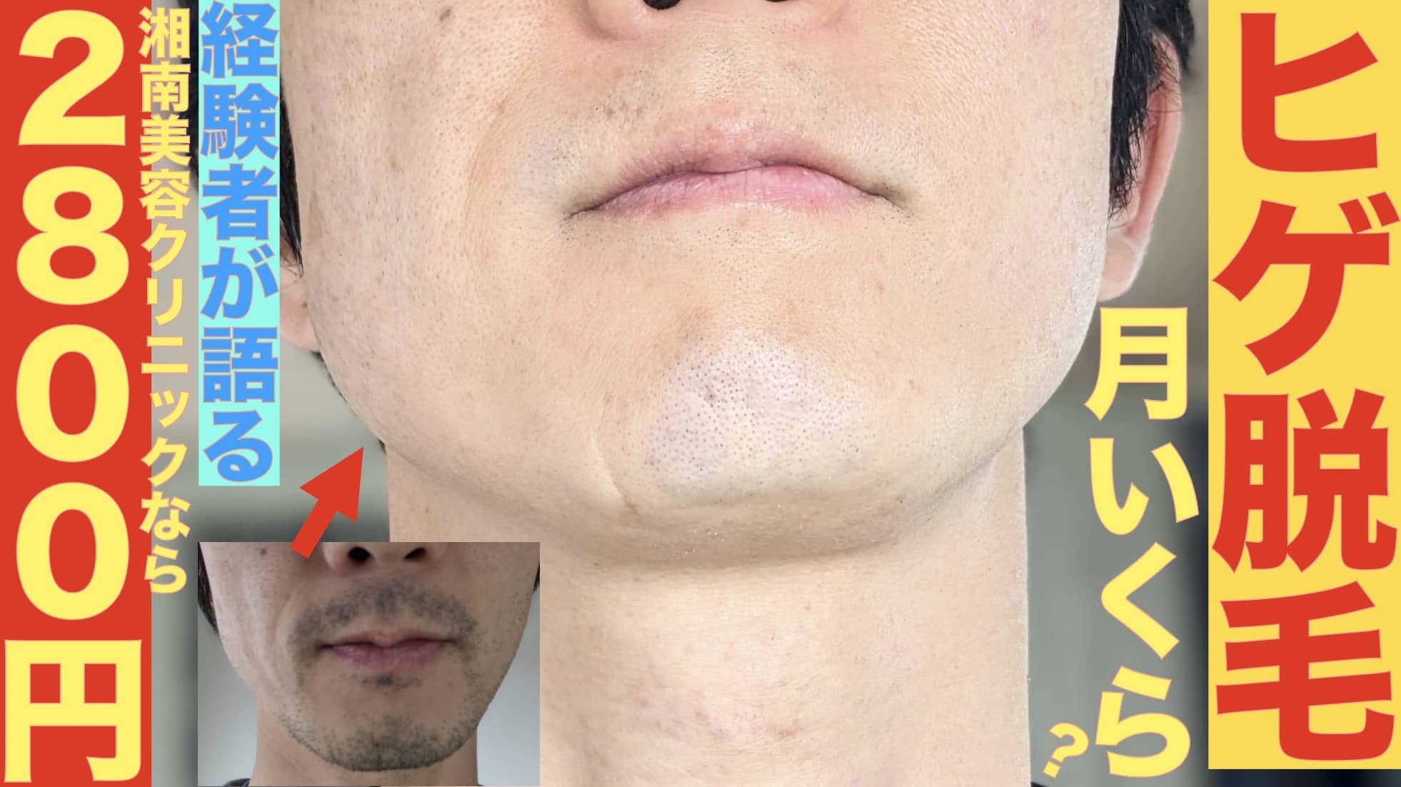 月いくらでヒゲ脱毛できる？湘南美容クリニックなら2800円〜サムネイル画像