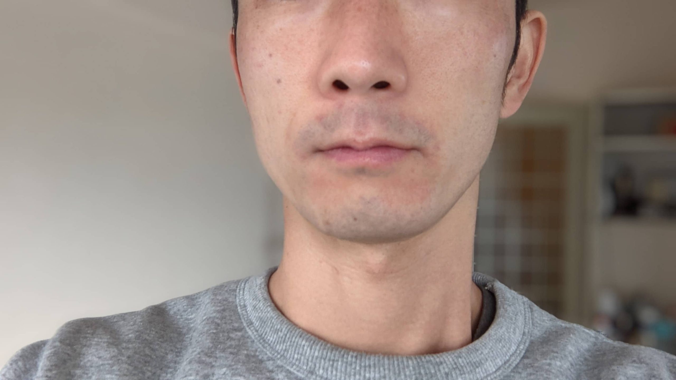 湘南美容クリニックでヒゲ脱毛受けた当日の肌の赤み1