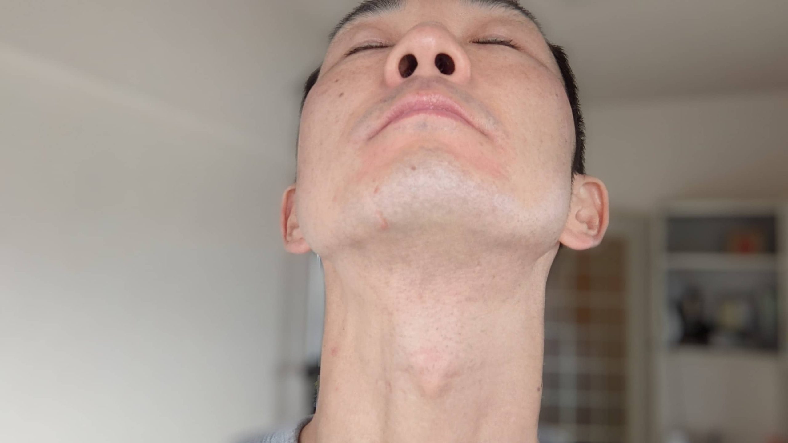 湘南美容クリニックでヒゲ脱毛受けた当日の肌の赤み（施術後2〜3時間経過）2