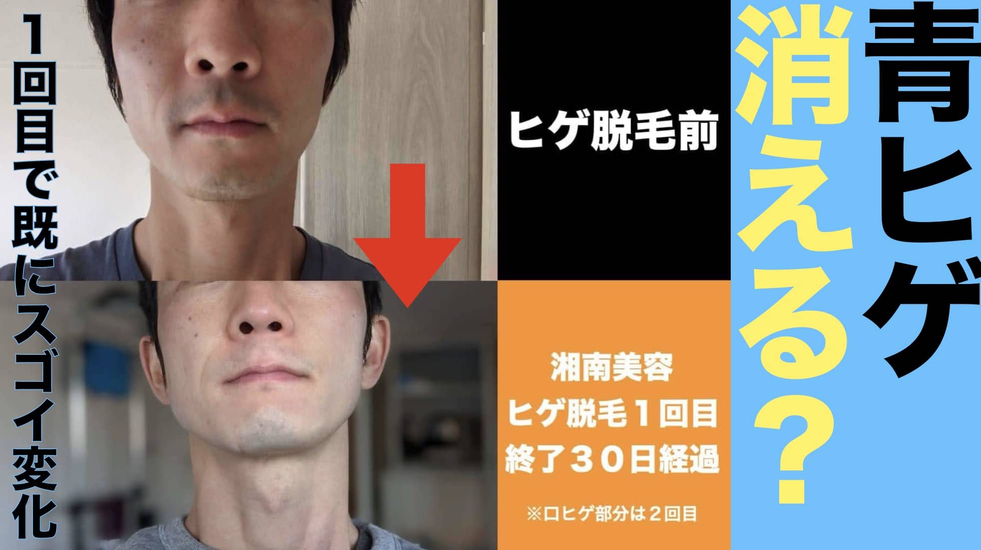 湘南美容クリニックのヒゲ脱毛は1回目から青ヒゲ薄くなるの？サムネイル画像