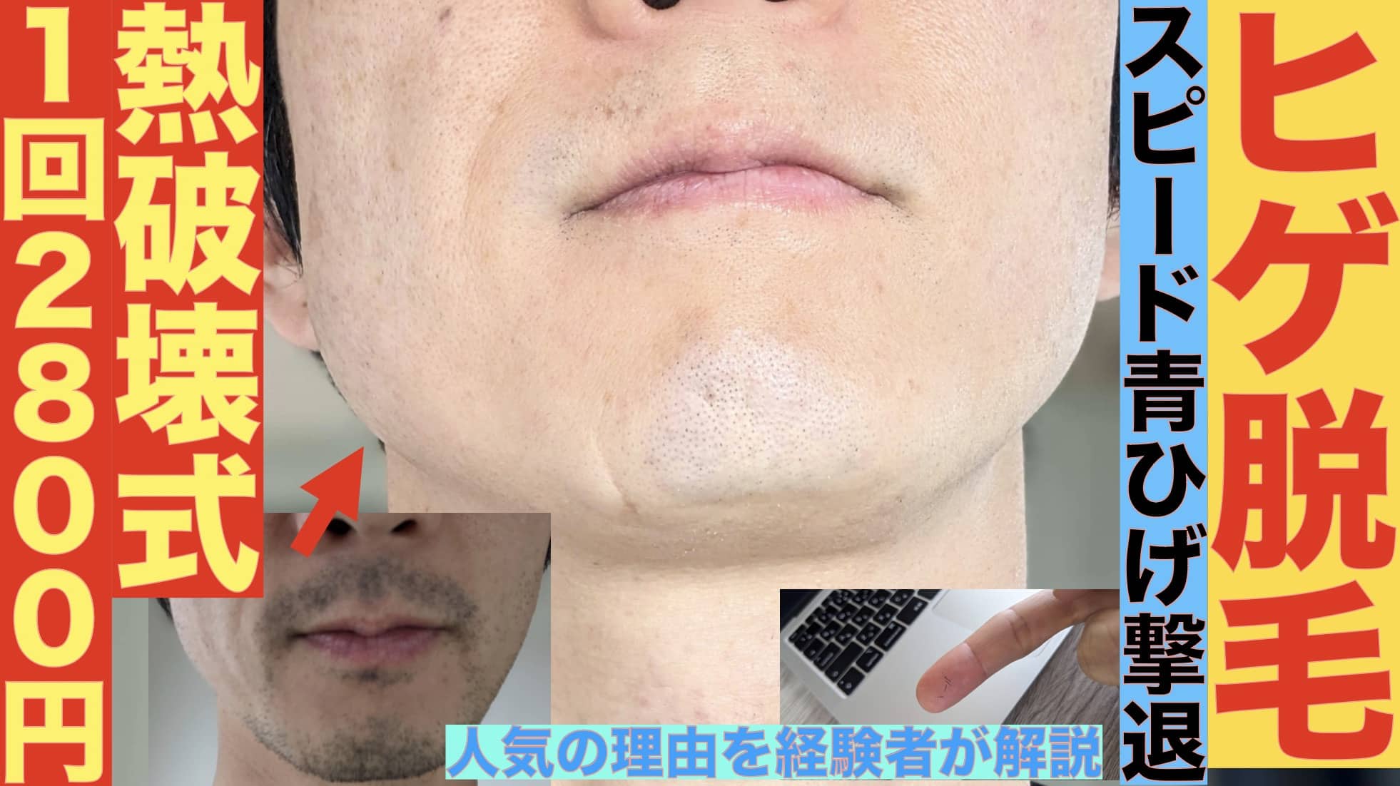 熱破壊式のヒゲ脱毛が1回2800円！湘南美容クリニックならマシン指定可能【蓄熱式も受けた筆者が違いを解説】サムネイル画像