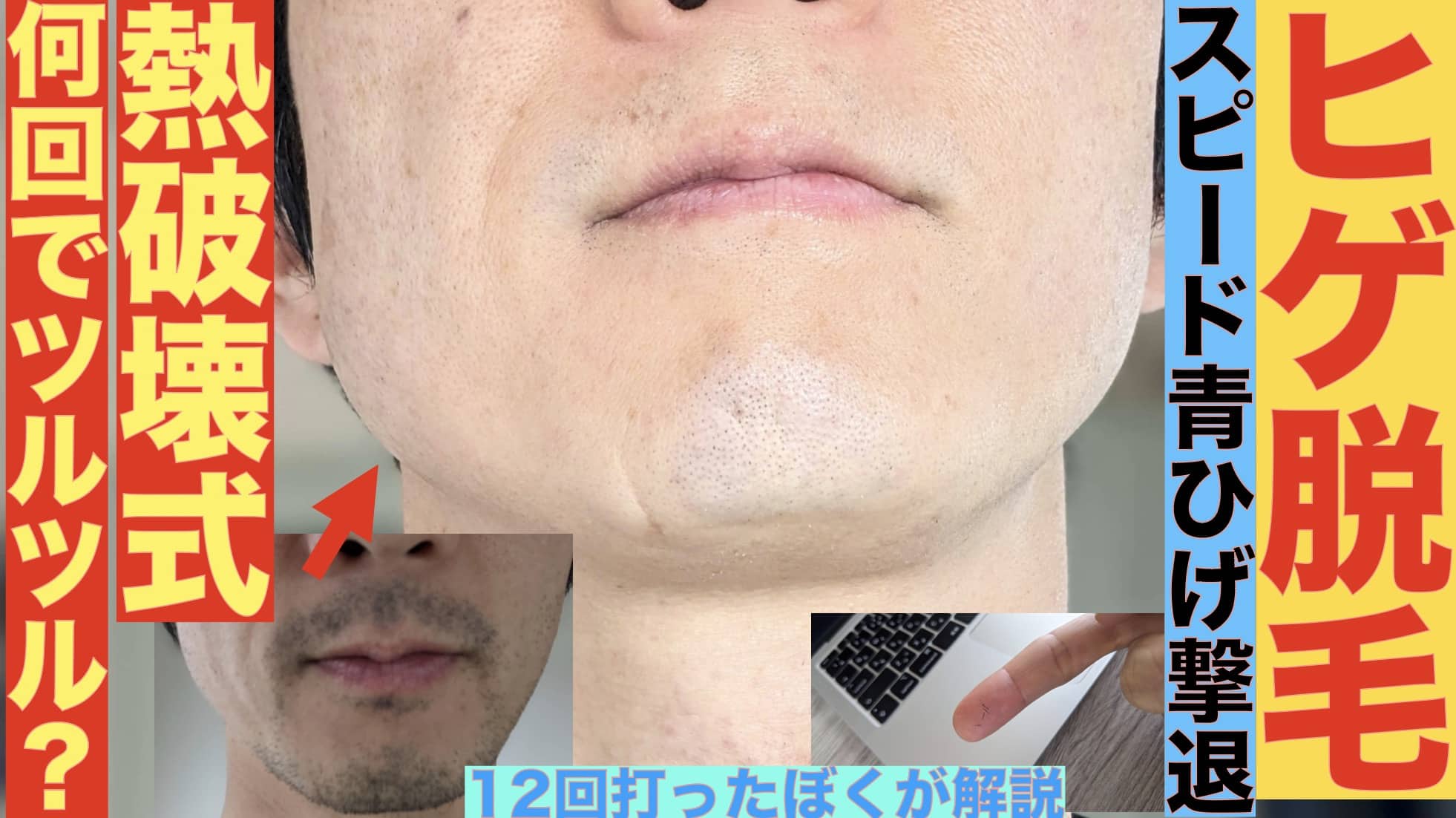 熱破壊式のヒゲ脱毛は何回でツルツルになる？湘南美容クリニックで12回打ったぼくが解説サムネイル画像