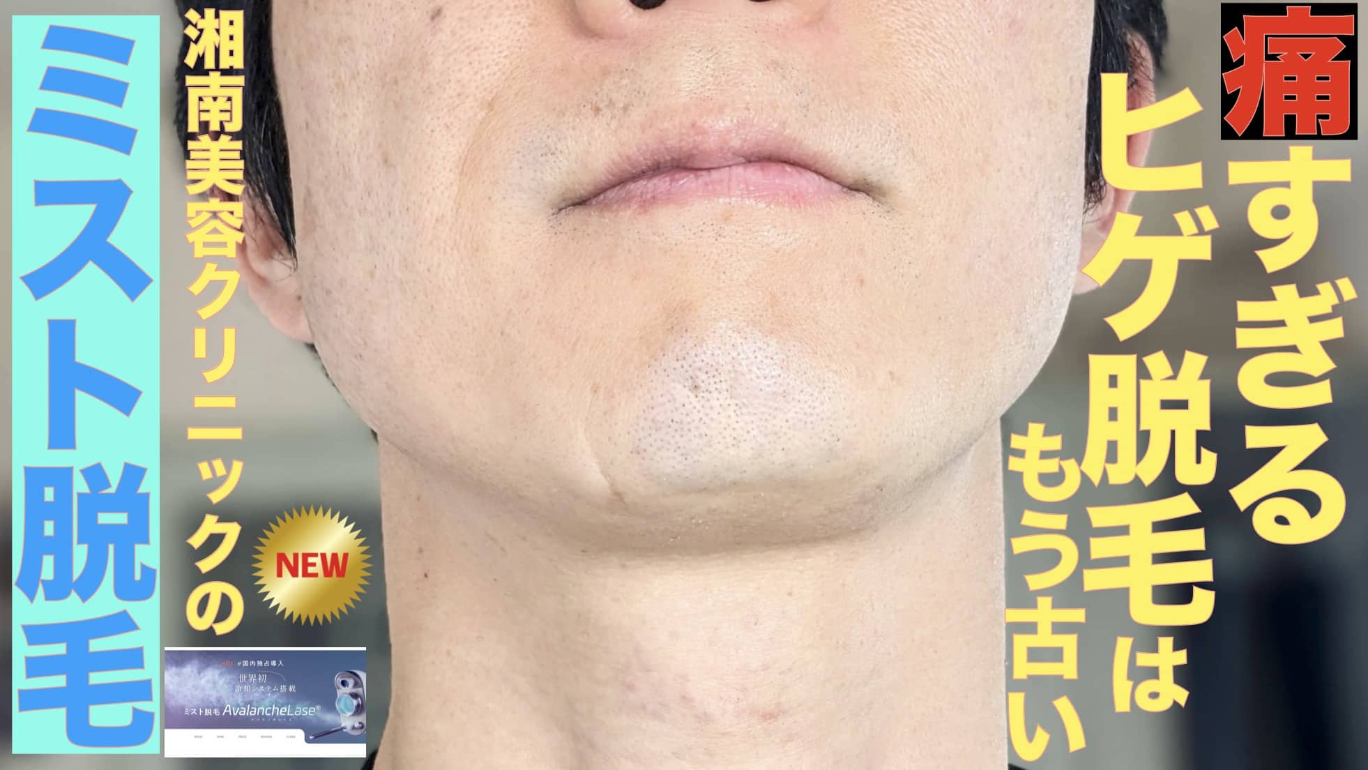 痛すぎるヒゲ脱毛は過去のもの！？湘南美容クリニックのミスト脱毛受けてきた【麻酔1回無料】サムネイル画像