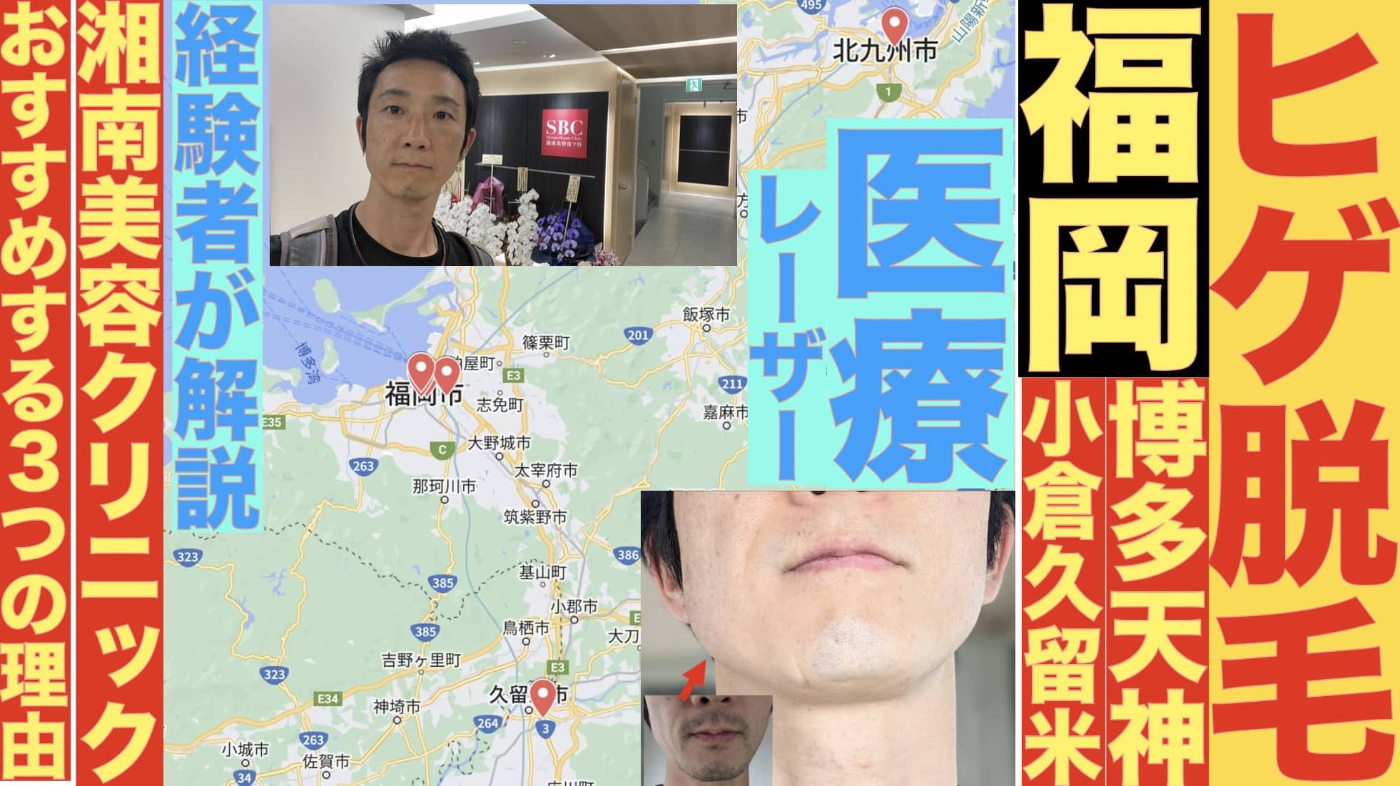 福岡の医療ヒゲ脱毛でおすすめは湘南美容クリニック。10カ所以上行った筆者が解説サムネイル画像