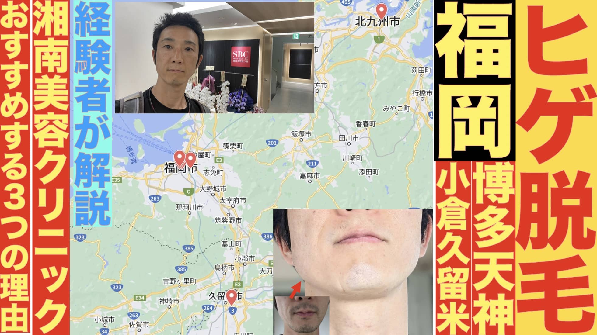 福岡の安いヒゲ脱毛は湘南美容クリニックがおすすめな3つの理由「10カ所以上実際に行ってわかった」サムネイル画像