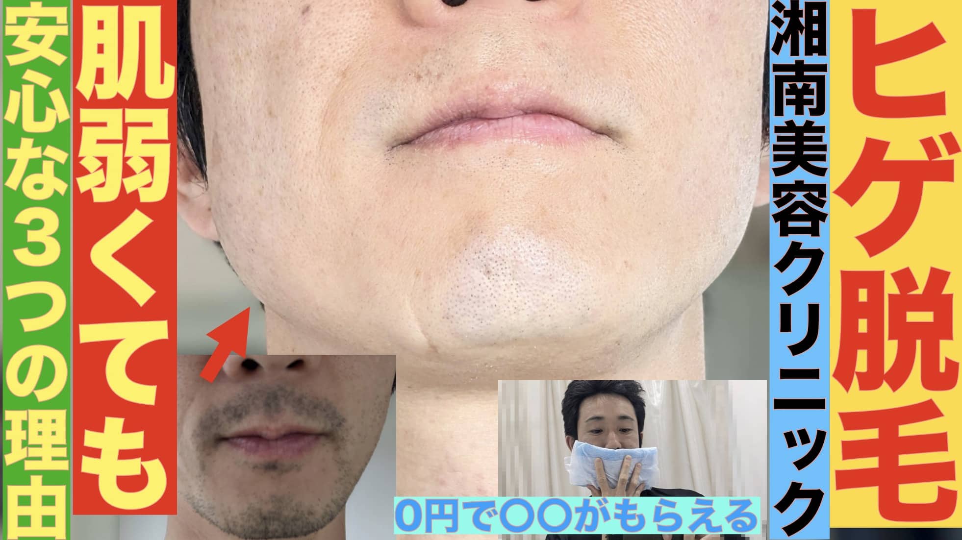 肌弱い人のヒゲ脱毛は湘南美容クリニックがおすすめな３つの理由「0円で万一の肌トラブルにも対応してくれる。新冷却マシンも導入」サムネイル画像