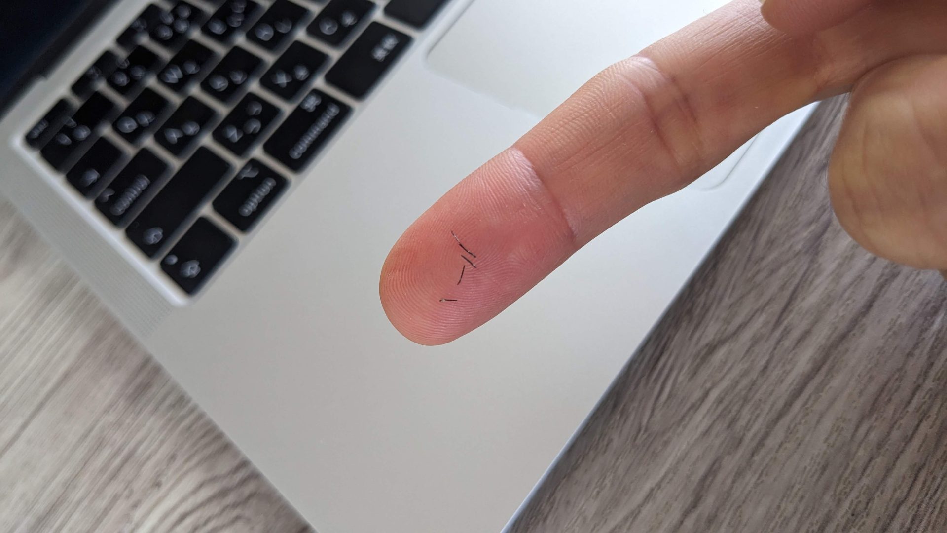 ぼくの経験では、レーザー照射後約7日～10日でヒゲがポロポロ抜け始めました。