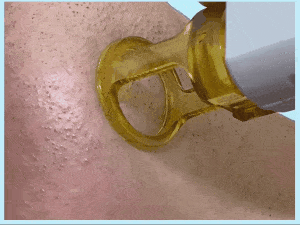 レーザー照射の様子