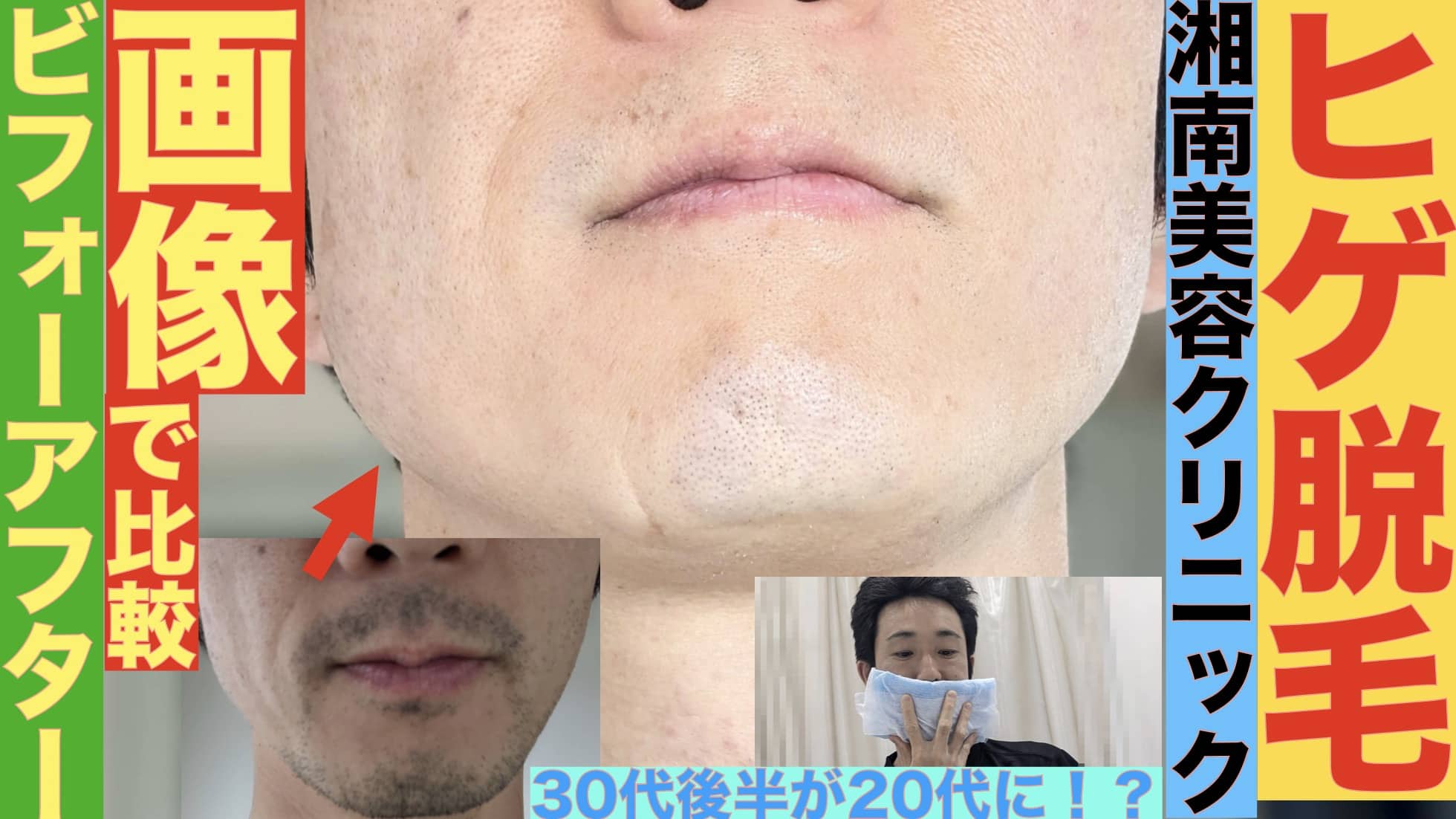 【画像多数】ヒゲ脱毛をアラフォーがやったらこう変わった【湘南美容クリニック】サムネイル画像