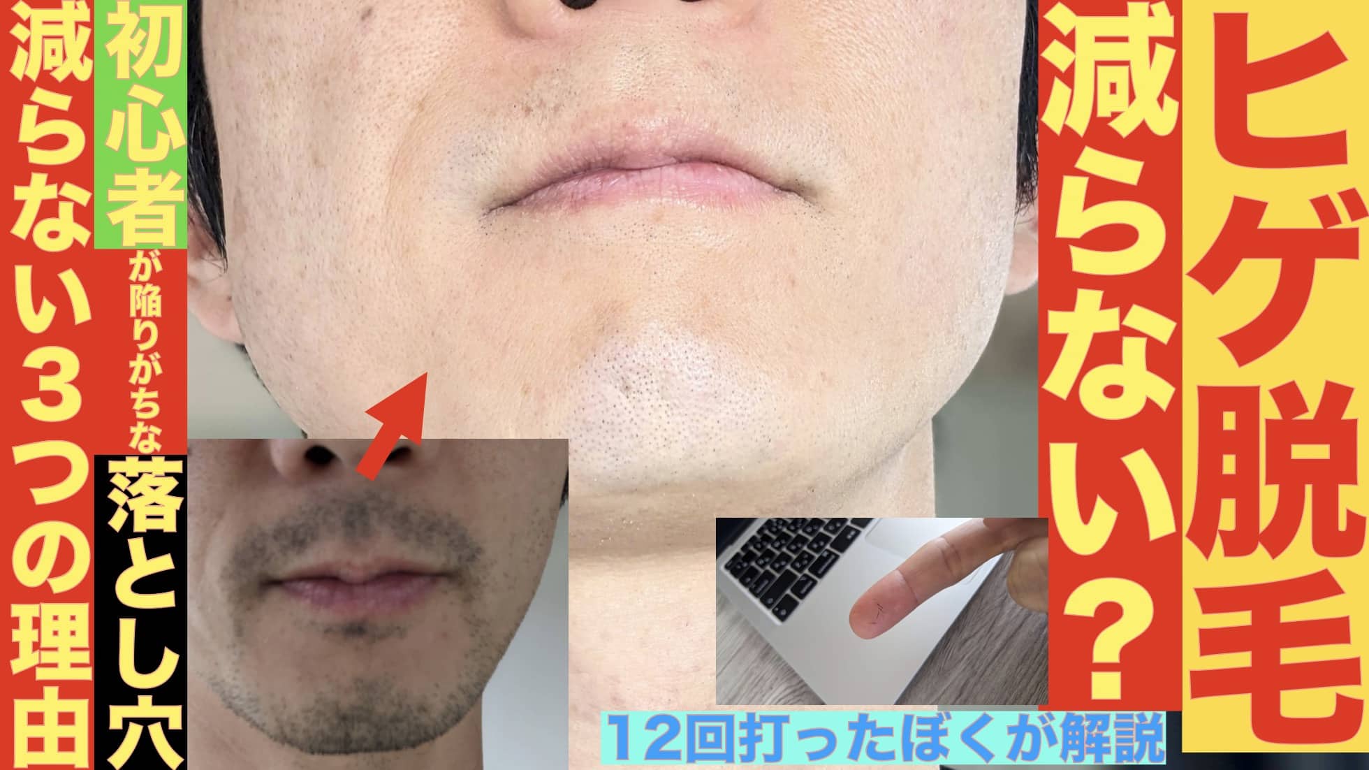 ヒゲ脱毛してるのに全然減らない？初心者が陥る３つの落とし穴。経験者曰く「脱毛サロンは永久脱毛できない」サムネイル画像