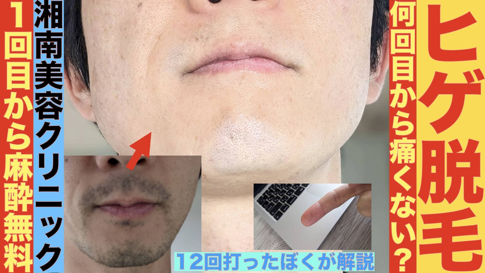 ヒゲ脱毛って何回目から痛くない？初回から麻酔が毎回無料な湘南美容クリニックサムネイル画像