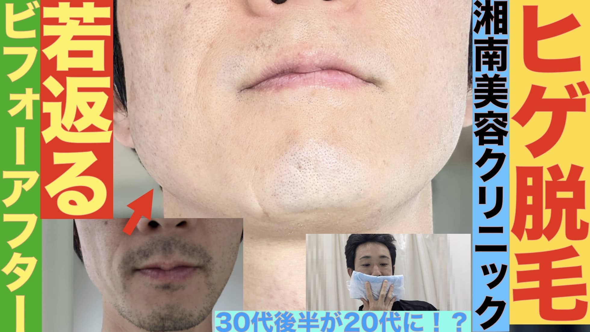 ヒゲ脱毛でどれだけ若返る？6回12回それぞれの時点の写真がこちらサムネイル画像