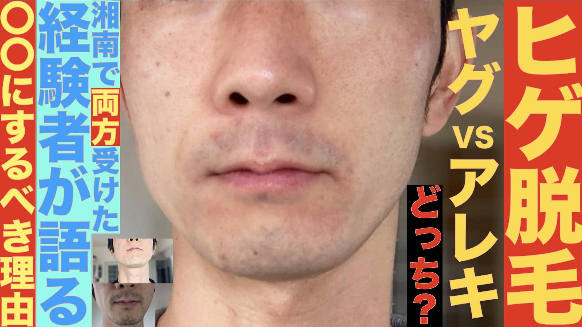 ヒゲ脱毛はヤグレーザー？アレキサンドライト？どっちで受けるべき？１２回経験者は〇〇をおすすめサムネイル画像