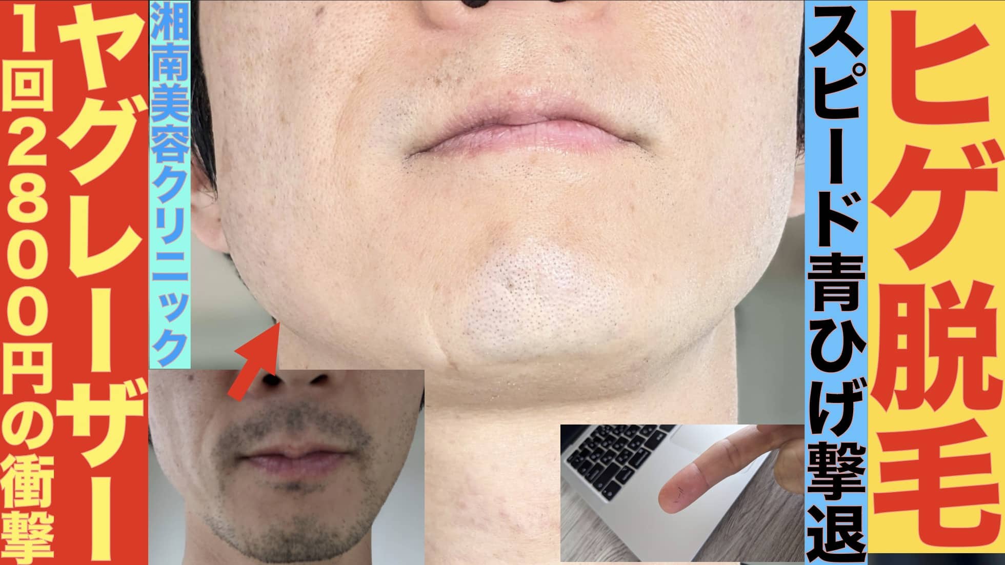 ヒゲ脱毛ヤグレーザー1回2800円で受けられる湘南美容クリニックがおすすめな３つの理由サムネイル画像