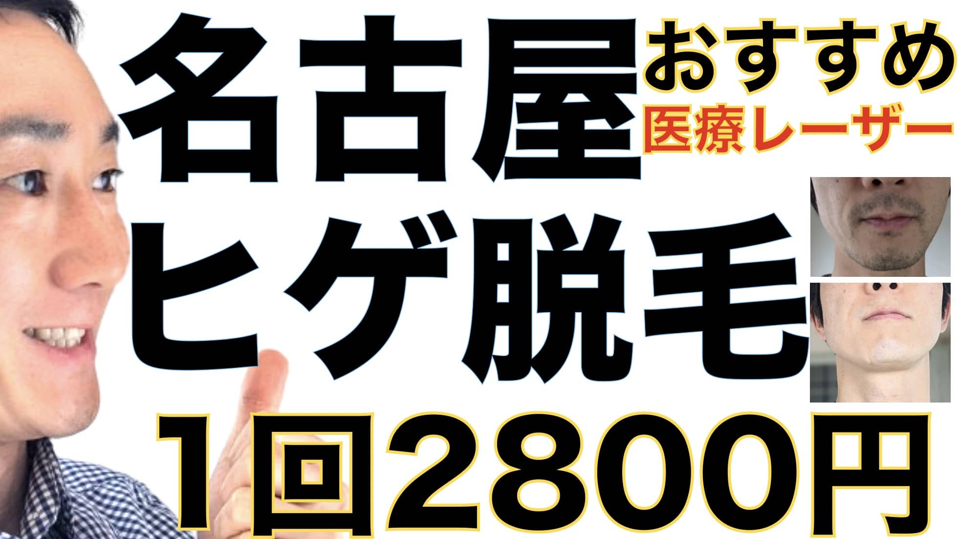 名古屋のヒゲ脱毛は湘南美容クリニックがおすすめな３つの理由【1回2800円で医療ヤグレーザー】サムネイル画像