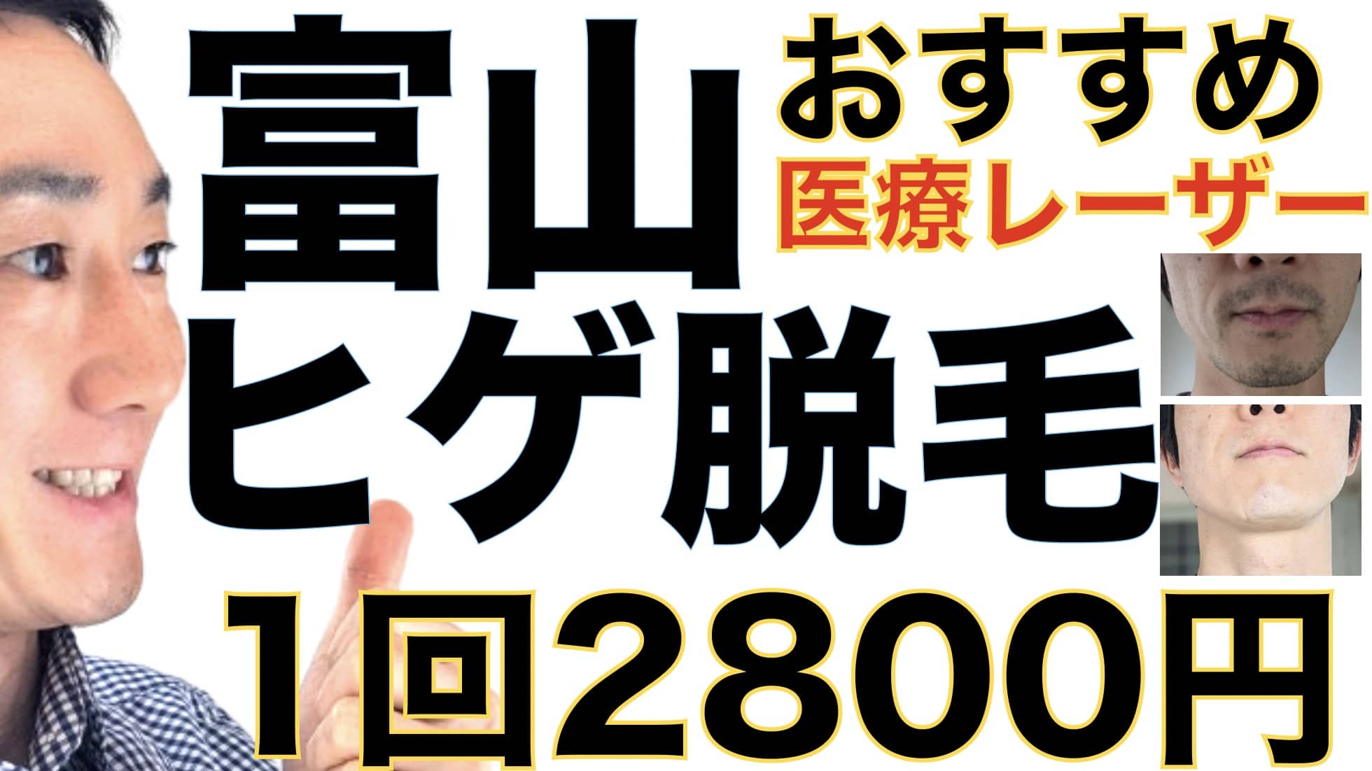 富山のヒゲ脱毛は湘南美容クリニックがおすすめな３つの理由【1回2800円で医療ヤグレーザー】サムネイル画像