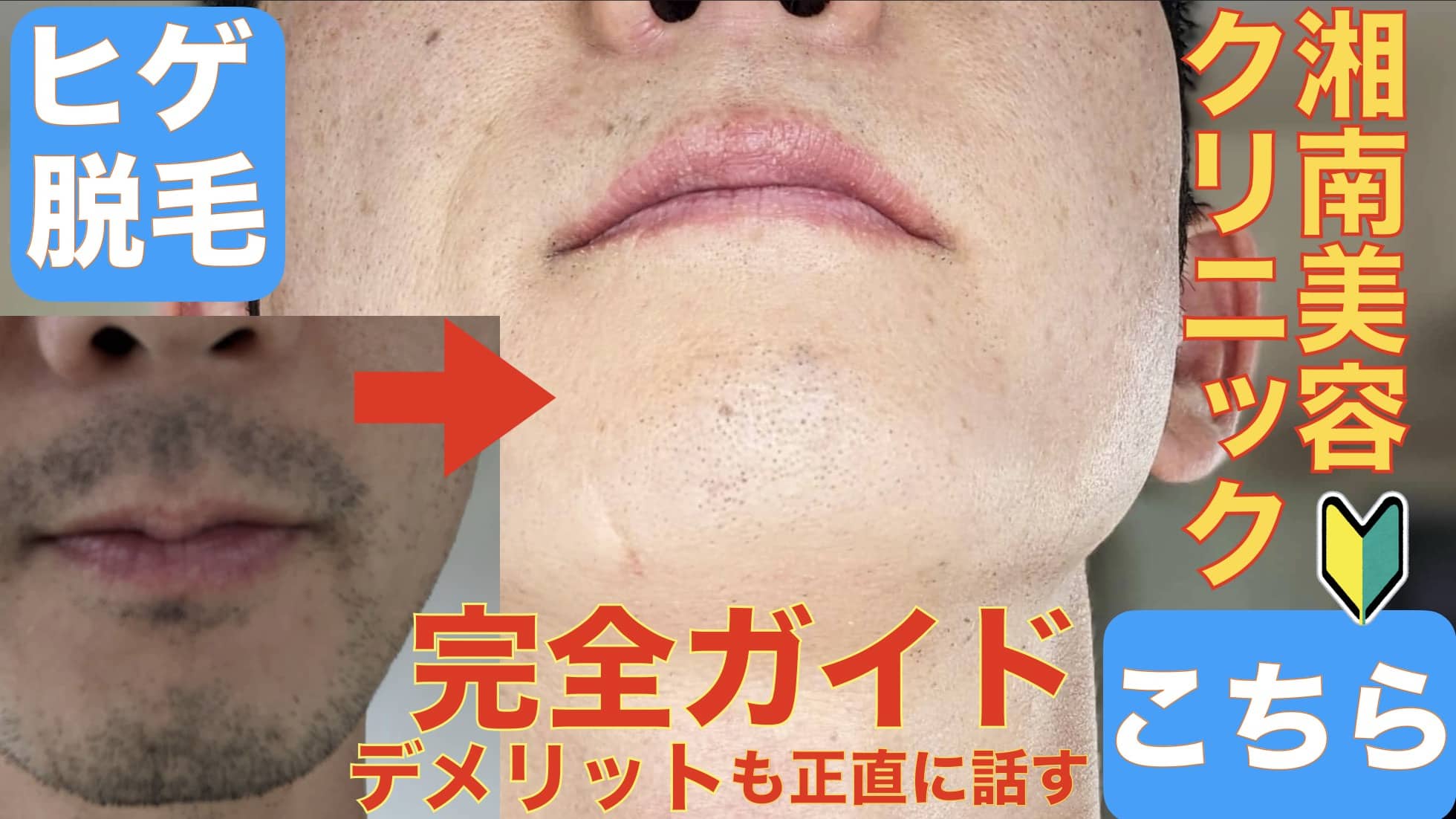 当ブログにようこそ！湘南美容クリニックのヒゲ脱毛予約方法やお得なクーポン情報サムネ2