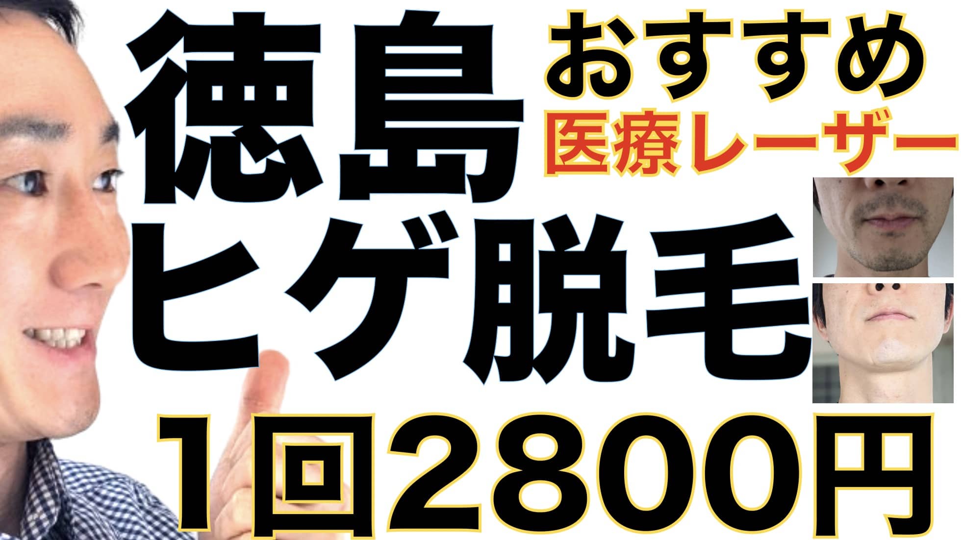徳島のヒゲ脱毛は湘南美容クリニックがおすすめな３つの理由【1回2800円で医療ヤグレーザー】サムネイル画像