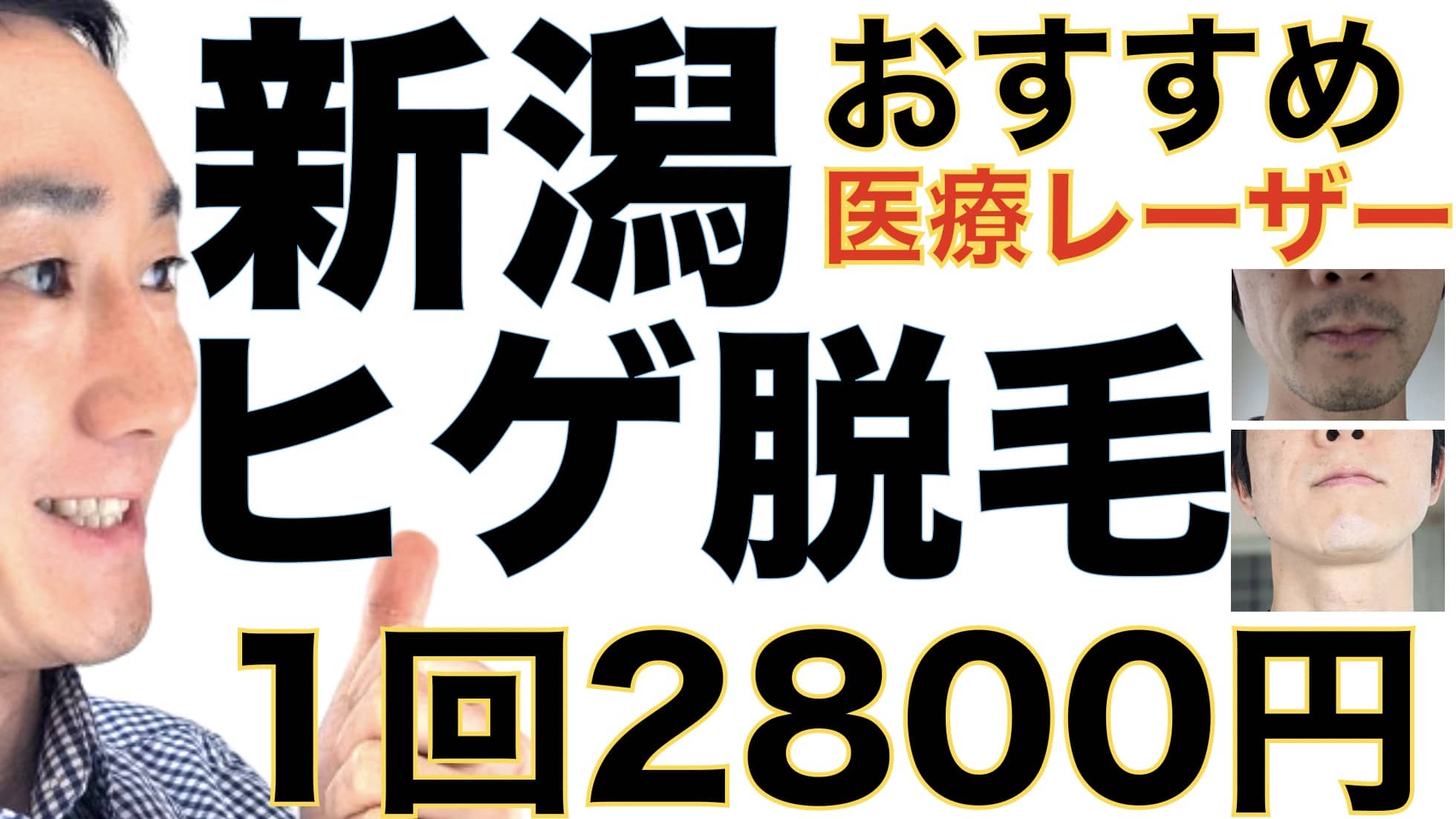 新潟でヒゲ脱毛するなら湘南美容クリニックがおすすめ！3つの理由で経験者が解説