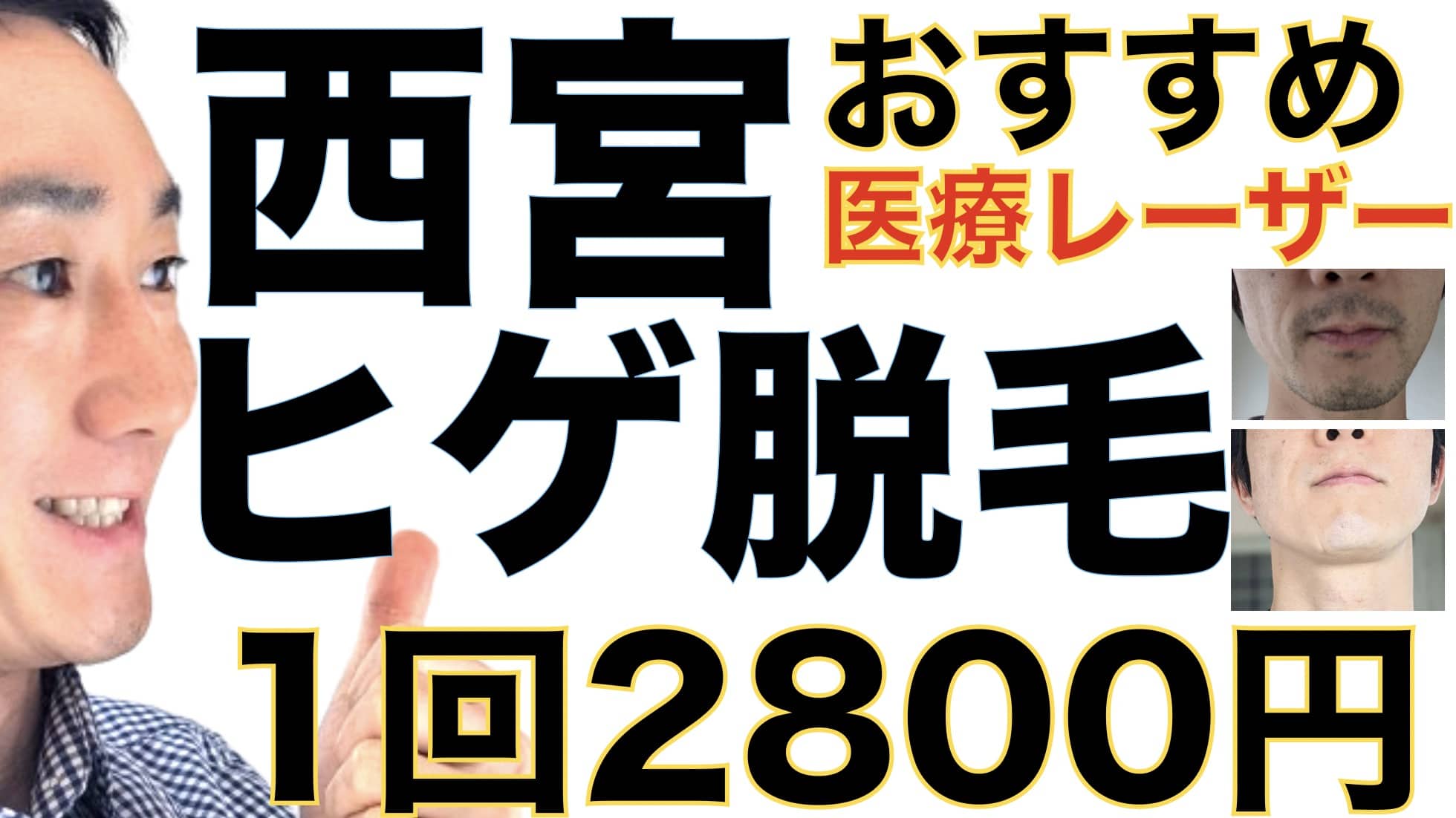 西宮のヒゲ脱毛は湘南美容クリニックがおすすめな３つの理由【1回2800円で医療ヤグレーザー】サムネイル画像