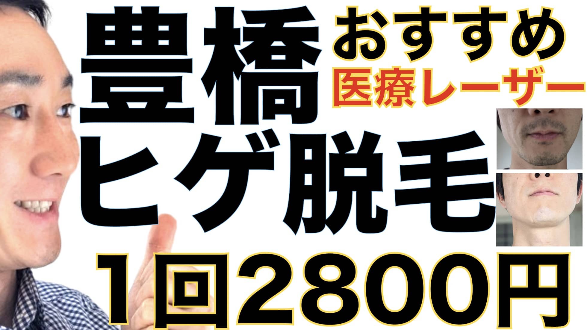 豊橋のヒゲ脱毛は湘南美容クリニックがおすすめな３つの理由【1回2800円で医療ヤグレーザー】サムネイル画像