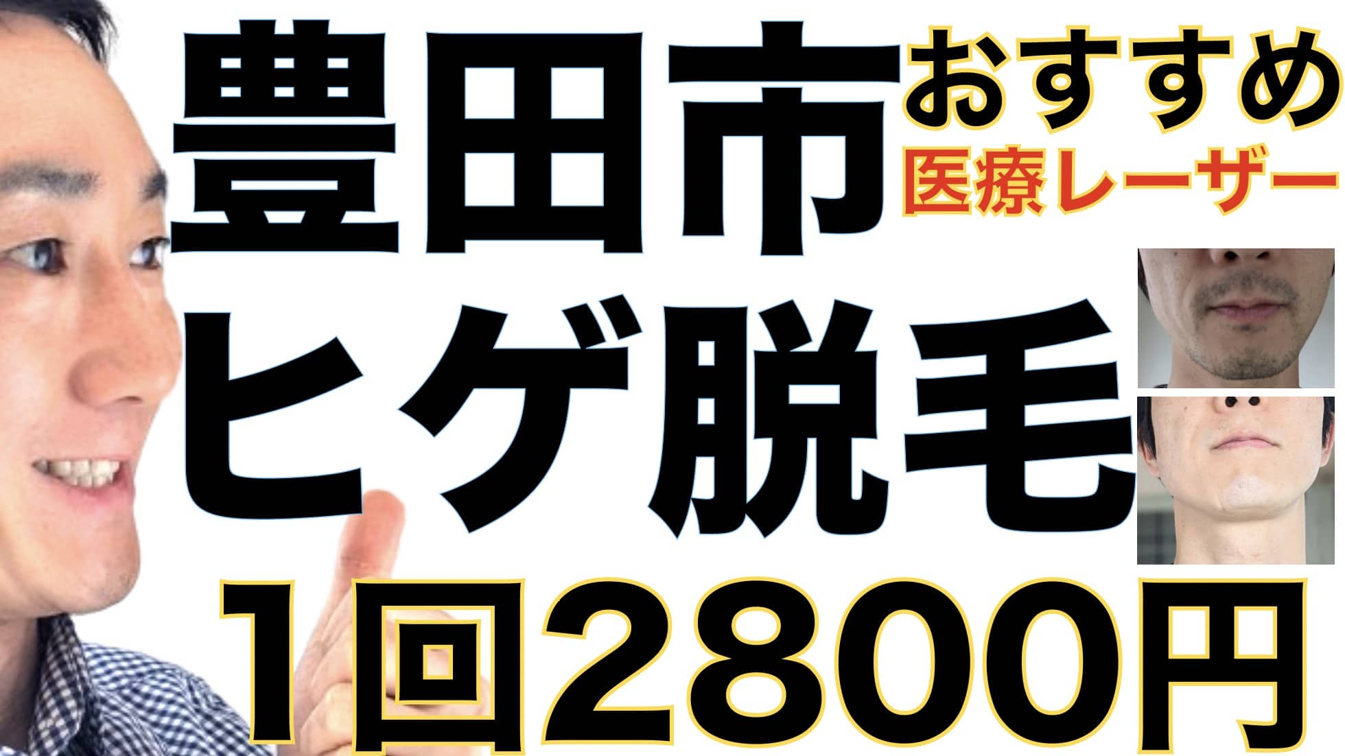 豊田市のヒゲ脱毛は湘南美容クリニックがおすすめな３つの理由【1回2800円で医療ヤグレーザー】サムネイル画像