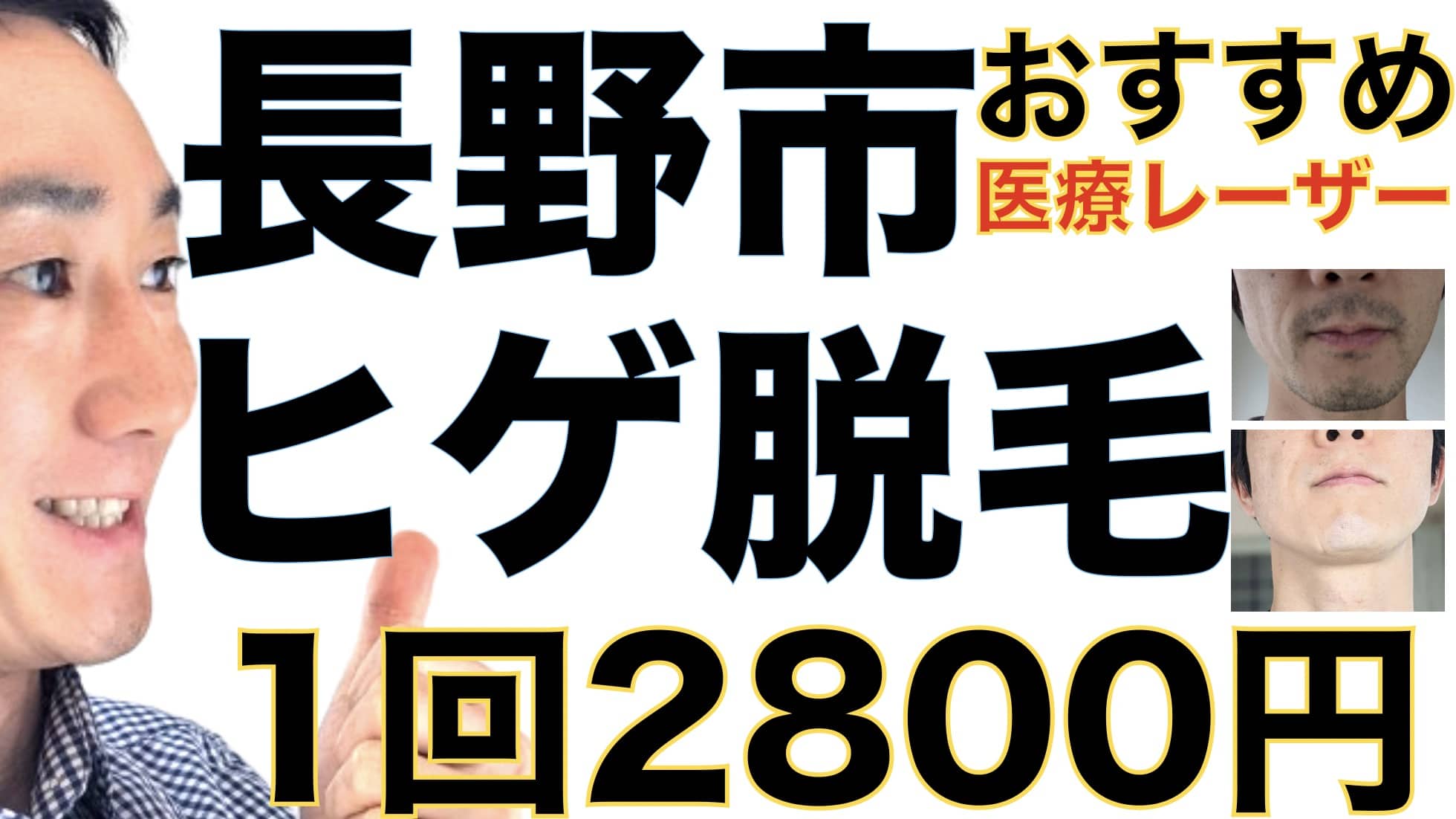 長野市のヒゲ脱毛は湘南美容クリニックがおすすめな３つの理由【1回2800円で医療ヤグレーザー】サムネイル画像