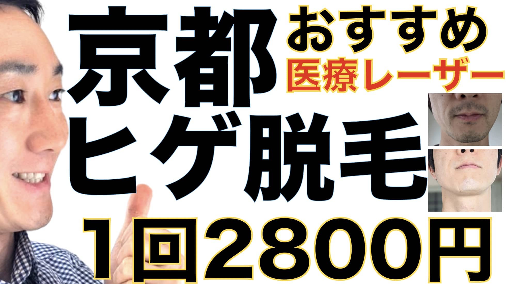 1回2800円で医療ヤグレーザー！京都でヒゲ脱毛なら湘南美容クリニックがおすすめな３つの理由サムネイル画像