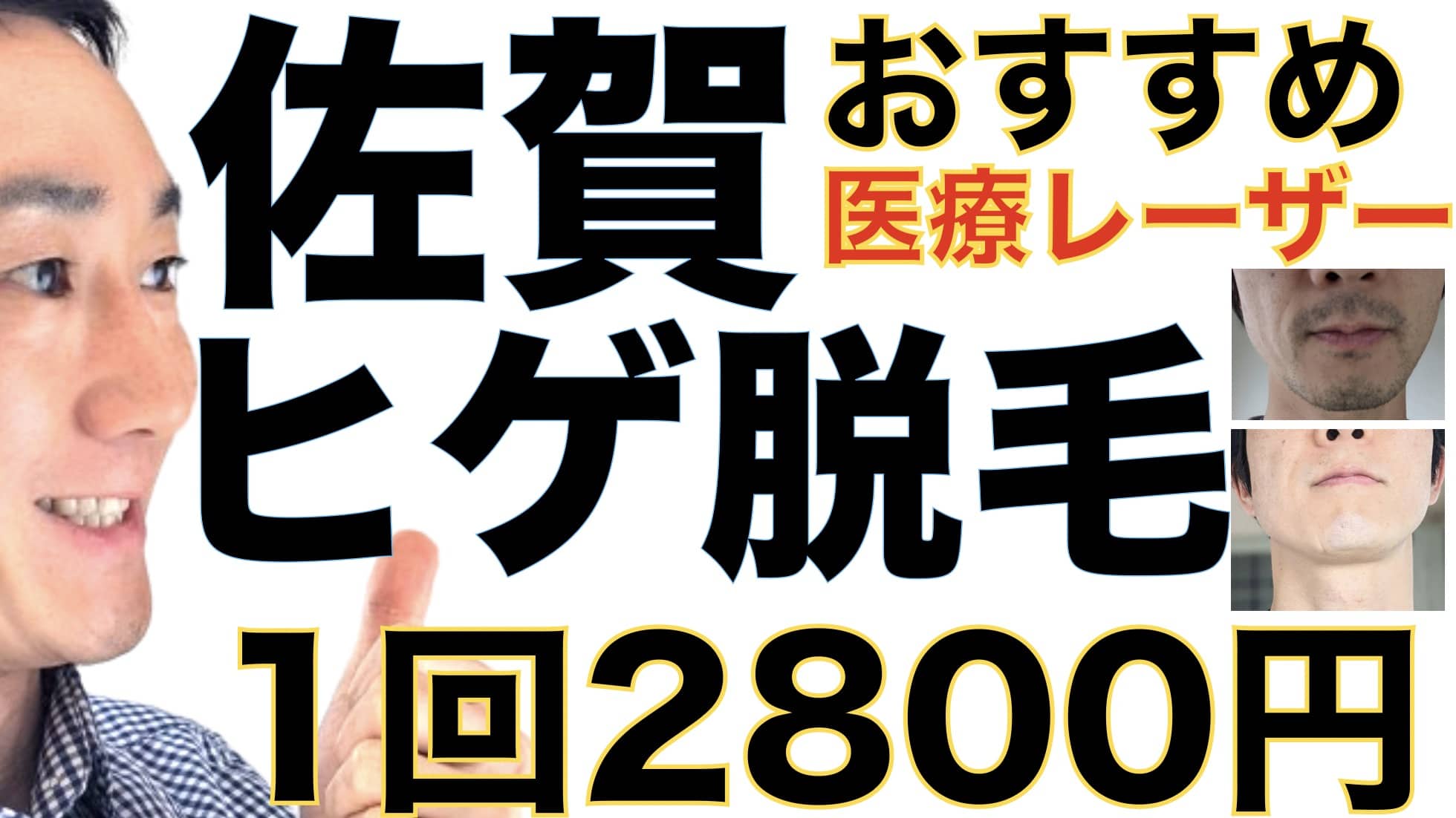 1回2800円で医療ヤグレーザー！佐賀のヒゲ脱毛は湘南美容クリニックがおすすめな３つの理由サムネイル画像