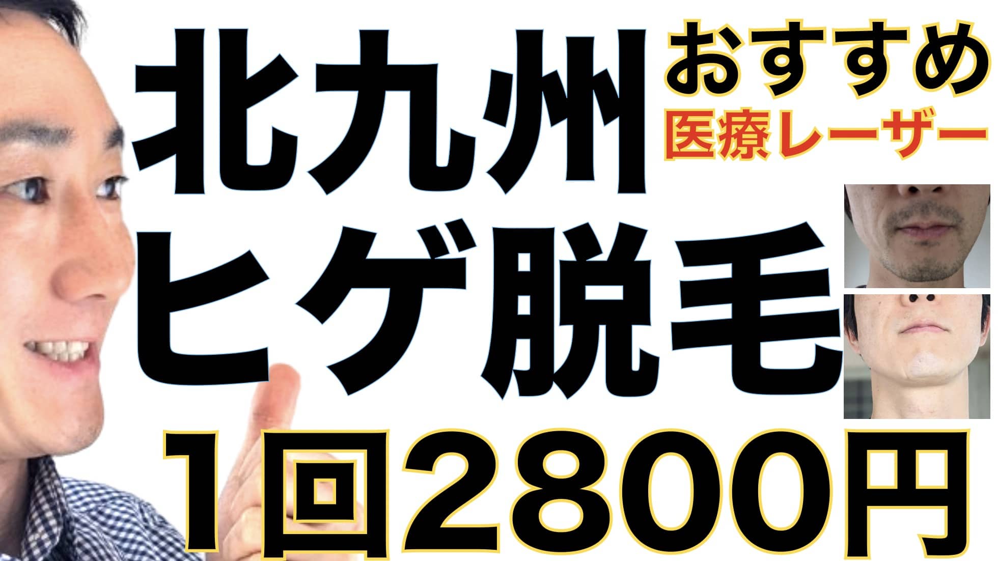 1回2800円で医療ヤグレーザー！北九州小倉でヒゲ脱毛なら湘南美容クリニックがおすすめな３つの理由サムネイル画像