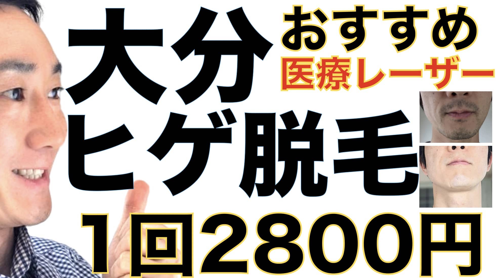 1回2800円で医療ヤグレーザー！大分でヒゲ脱毛なら湘南美容クリニックがおすすめな３つの理由サムネイル画像